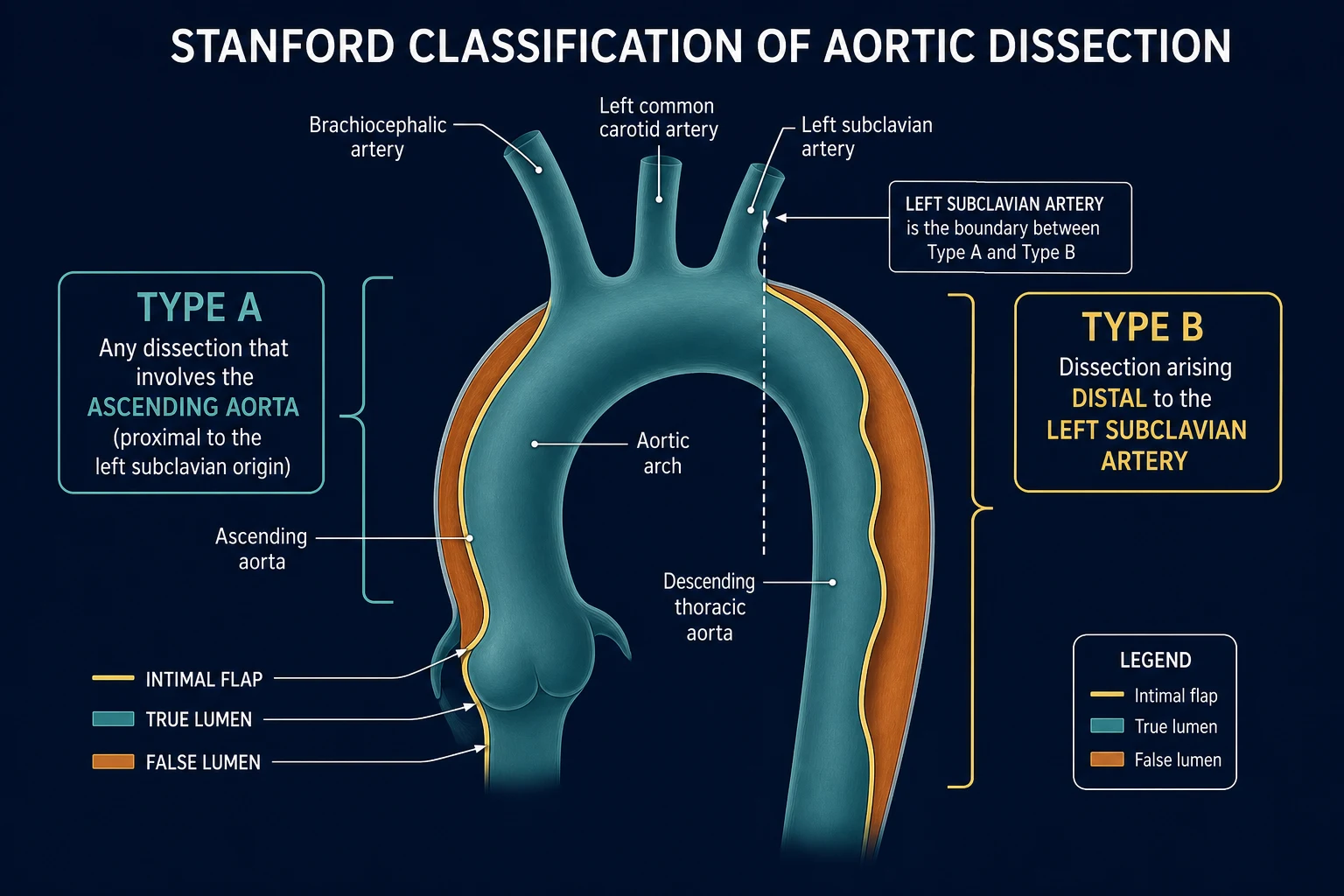 Diagram of the Stanford and DeBakey classifications of aortic dissection