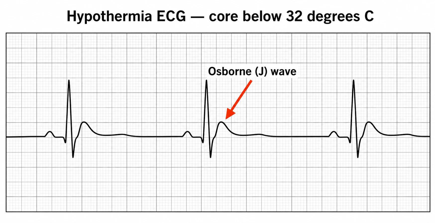 A labelled ECG rhythm strip showing sinus bradycardia with a prominent Osborne J wave — a positive deflection at the junction of the QRS complex and the ST segment