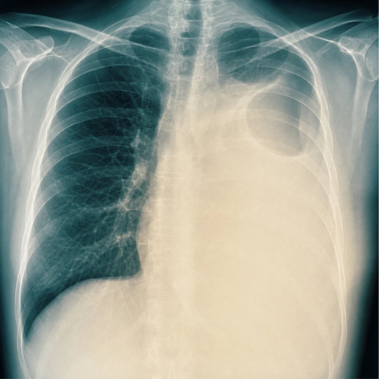 A chest radiograph showing a large right pleural effusion with blunting of the costophrenic angle