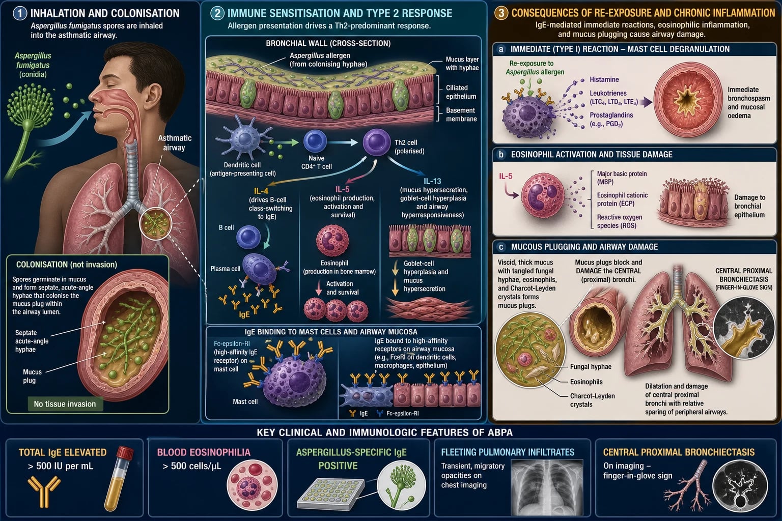 Medical mechanism infographic of ABPA immunopathogenesis — inhaled Aspergillus conidia colonising asthmatic/CF airways, Th2 response with IL-4, IL-5 and IL-13 driving IgE class-switching and eosinophilia, eosinophilic bronchitis, mucoid impaction and proximal bronchiectasis