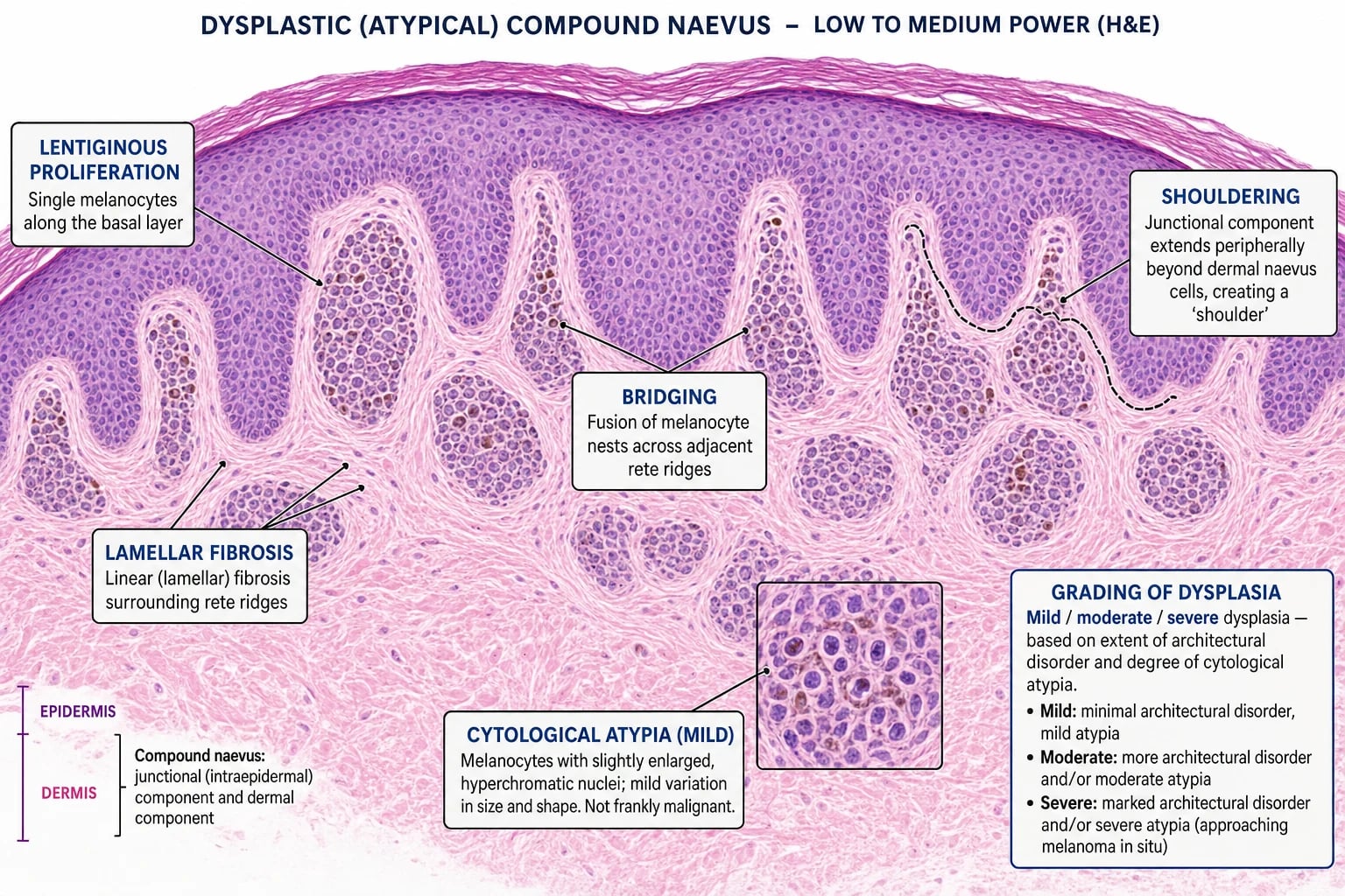H&E showing architectural disorder with shouldering, bridging, lamellar fibrosis, and cytological atypia with grading