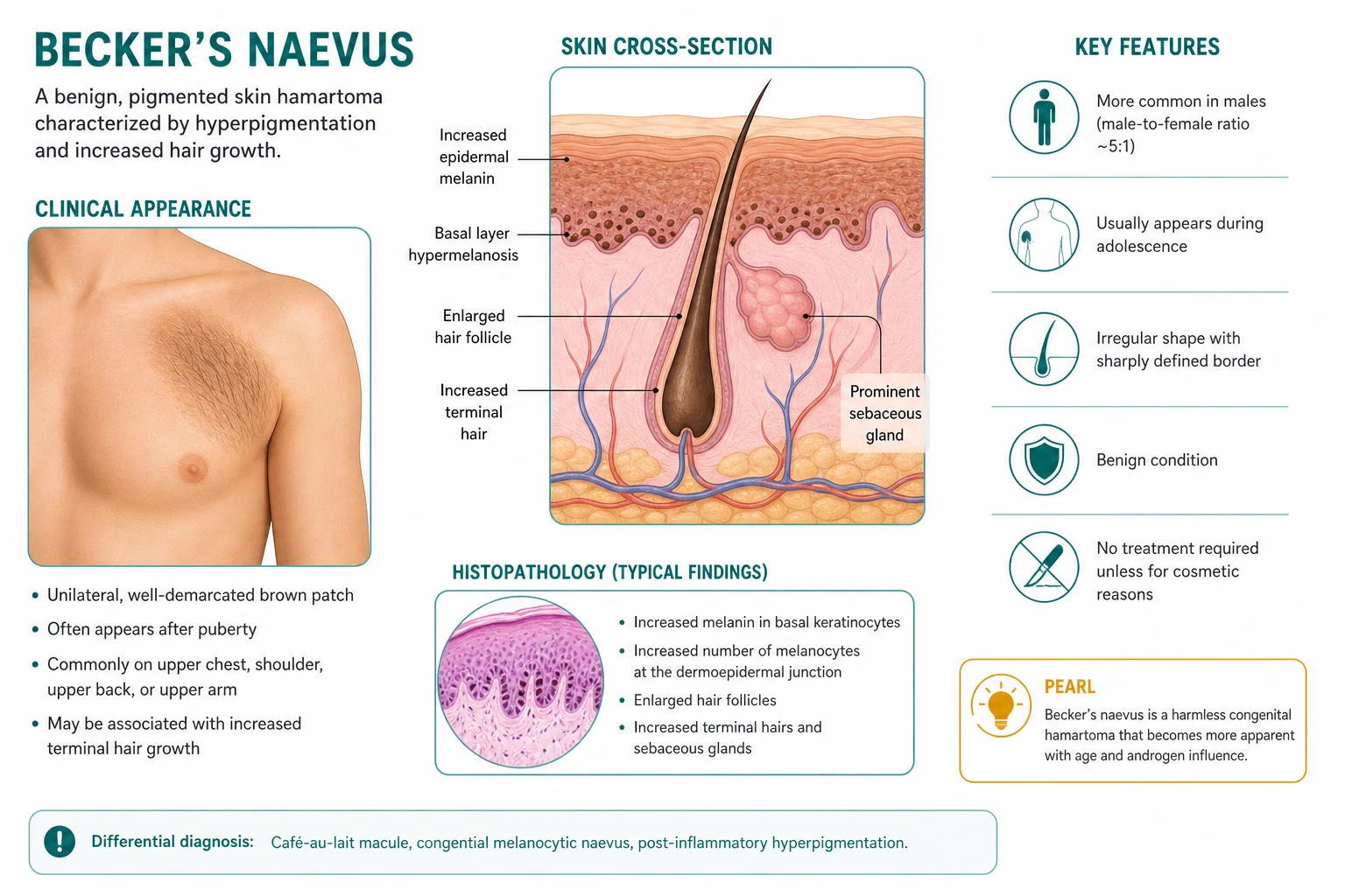 Diagram of skin showing thickened epidermis with basal hyperpigmentation, enlarged hair follicle with terminal hair, and hypertrophied arrector pili smooth muscle
