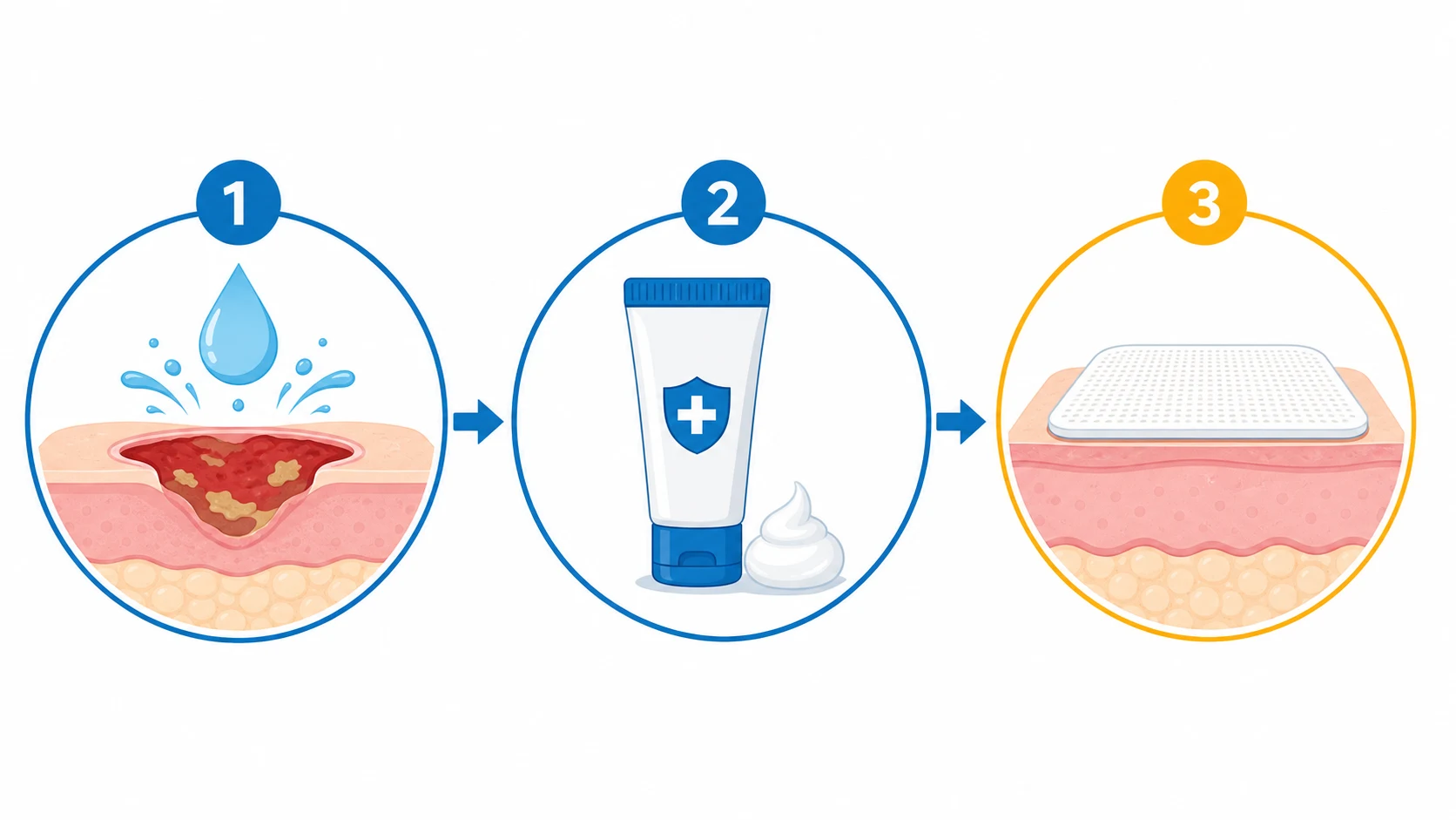 Three horizontal panels connected by arrows: wound-cleaning water drop (debridement), cream tube (topical antimicrobial), layered skin patch (dressing/graft), on a white clinical-blue background