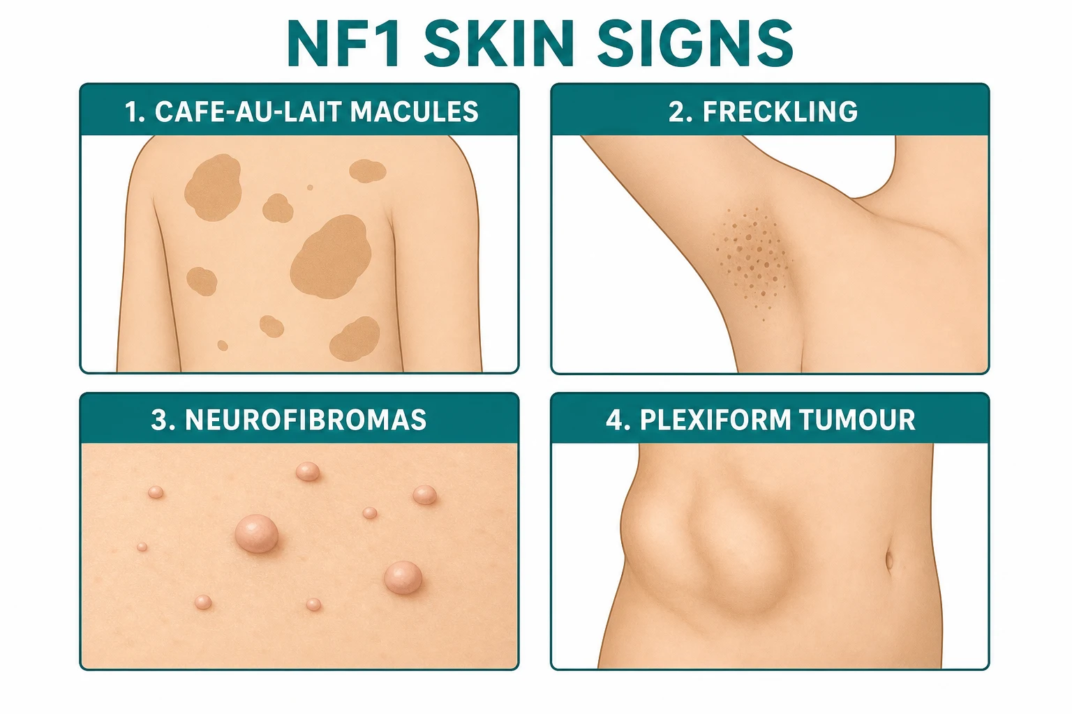 4 skin features: CALMs (light brown macules), freckling (axillary/inguinal; Crowe sign), cutaneous neurofibromas (soft fleshy; buttonhole sign; puberty), plexiform neurofibroma (bag of worms; MPNST risk)