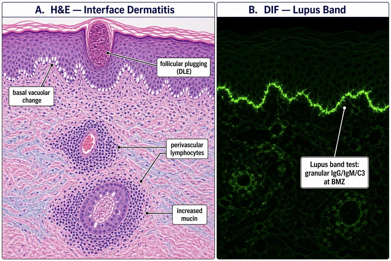 H&E showing interface dermatitis with basal vacuolar change, perivascular lymphocytic infiltrate and increased dermal mucin, plus DIF showing granular IgG/IgM/C3 at the basement membrane zone (lupus band)