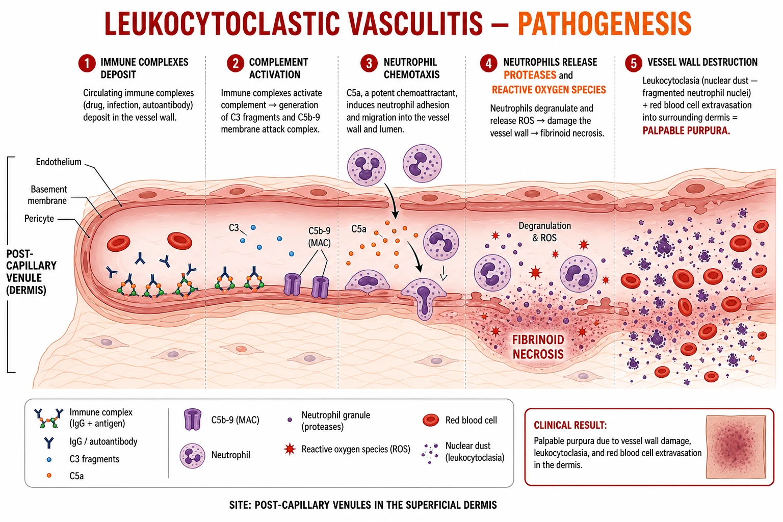 Immune complex deposition in post-capillary venule → complement activation → neutrophil chemotaxis → fibrinoid necrosis → leukocytoclasia → RBC extravasation → palpable purpura