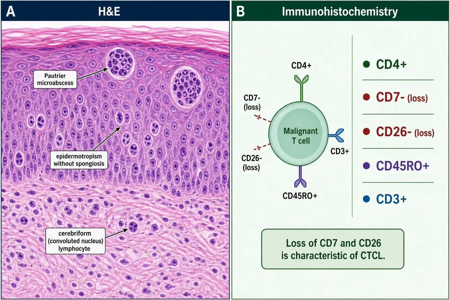 H&E showing Pautrier microabscesses (intraepidermal clusters of atypical lymphocytes with haloes), epidermotropism without spongiosis, cerebriform lymphocytes; immunohistochemistry shows CD4+ T cells with aberrant loss of CD7 and CD26, and CD30+ in transformation