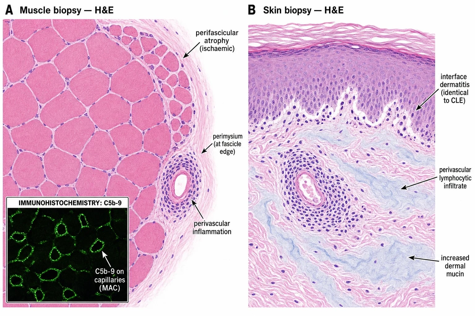 Muscle biopsy H&E showing perifascicular atrophy with C5b-9 MAC deposition on endomysial capillaries; skin biopsy H&E showing interface dermatitis identical to CLE
