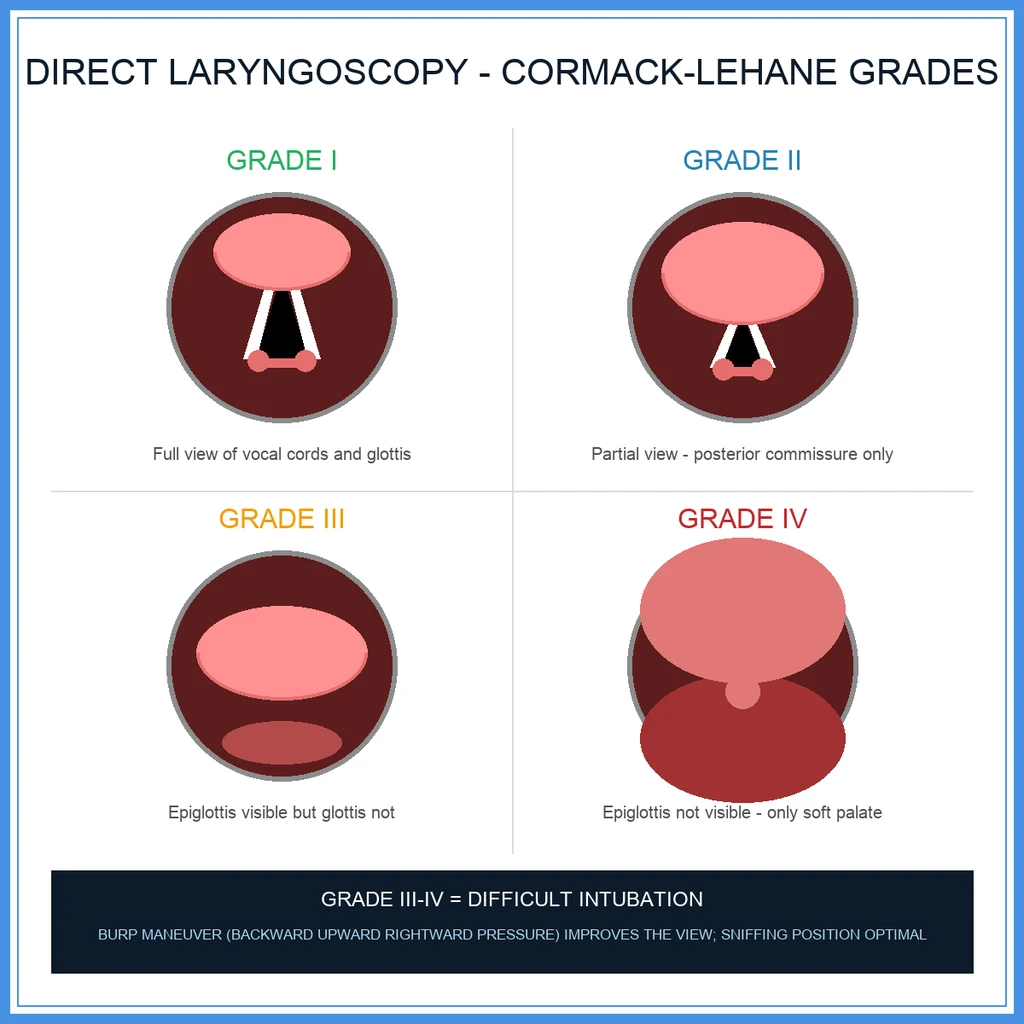 Direct laryngoscopy & orotracheal intubation — blade types, Cormack-Lehane grade, BURP, ETT selection and confirmation