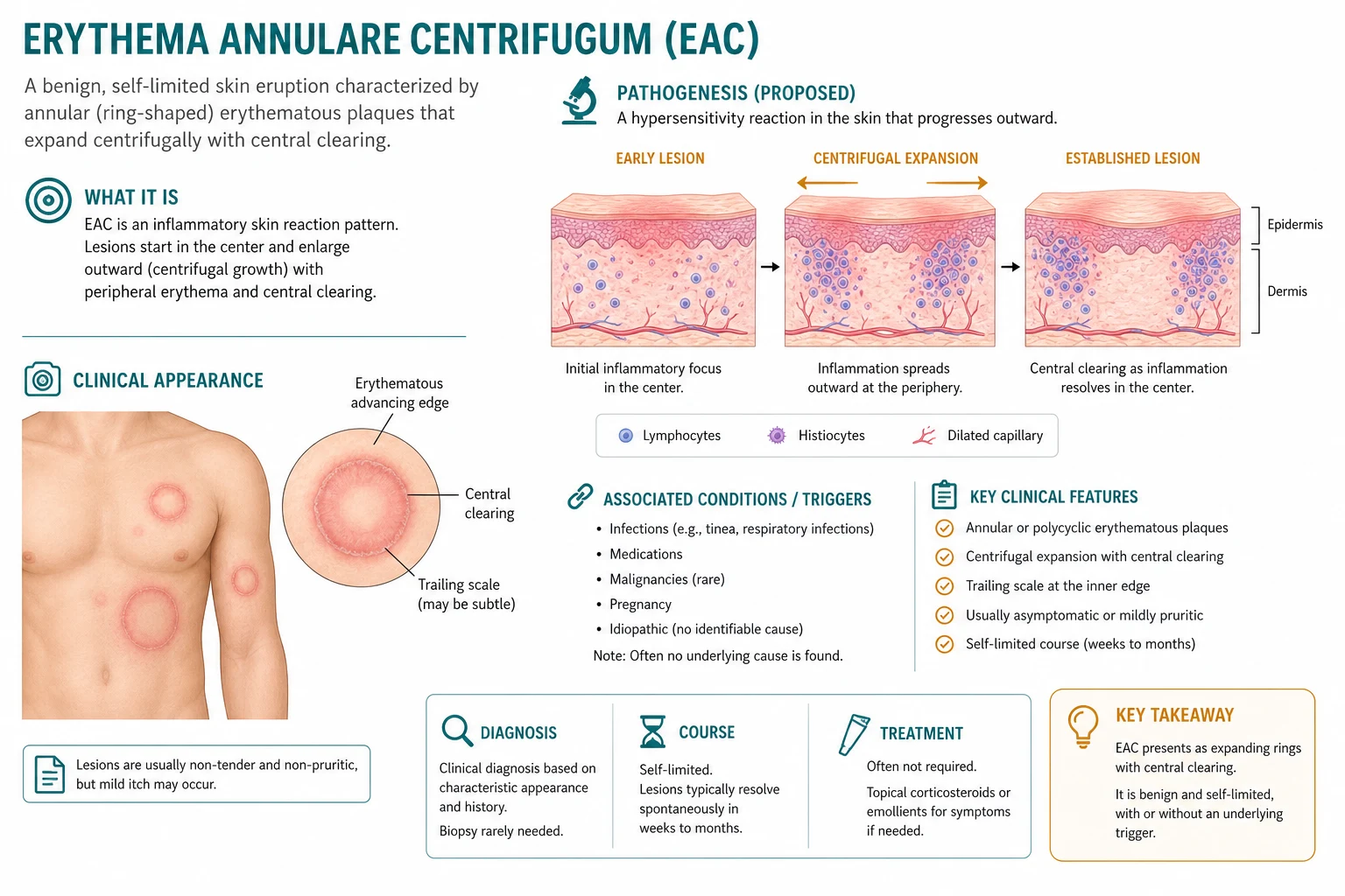 Diagram of EAC pathophysiology: distant antigen triggers type IV hypersensitivity with activated T-cell migration producing centrifugal expansion and trailing inner scale, with the coat-sleeve perivascular infiltrate on histology