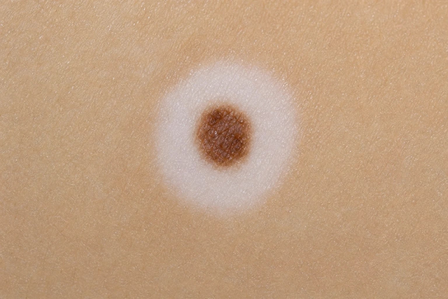 Annular and polycyclic erythematous rings with trailing inner scale on the trunk and proximal thigh