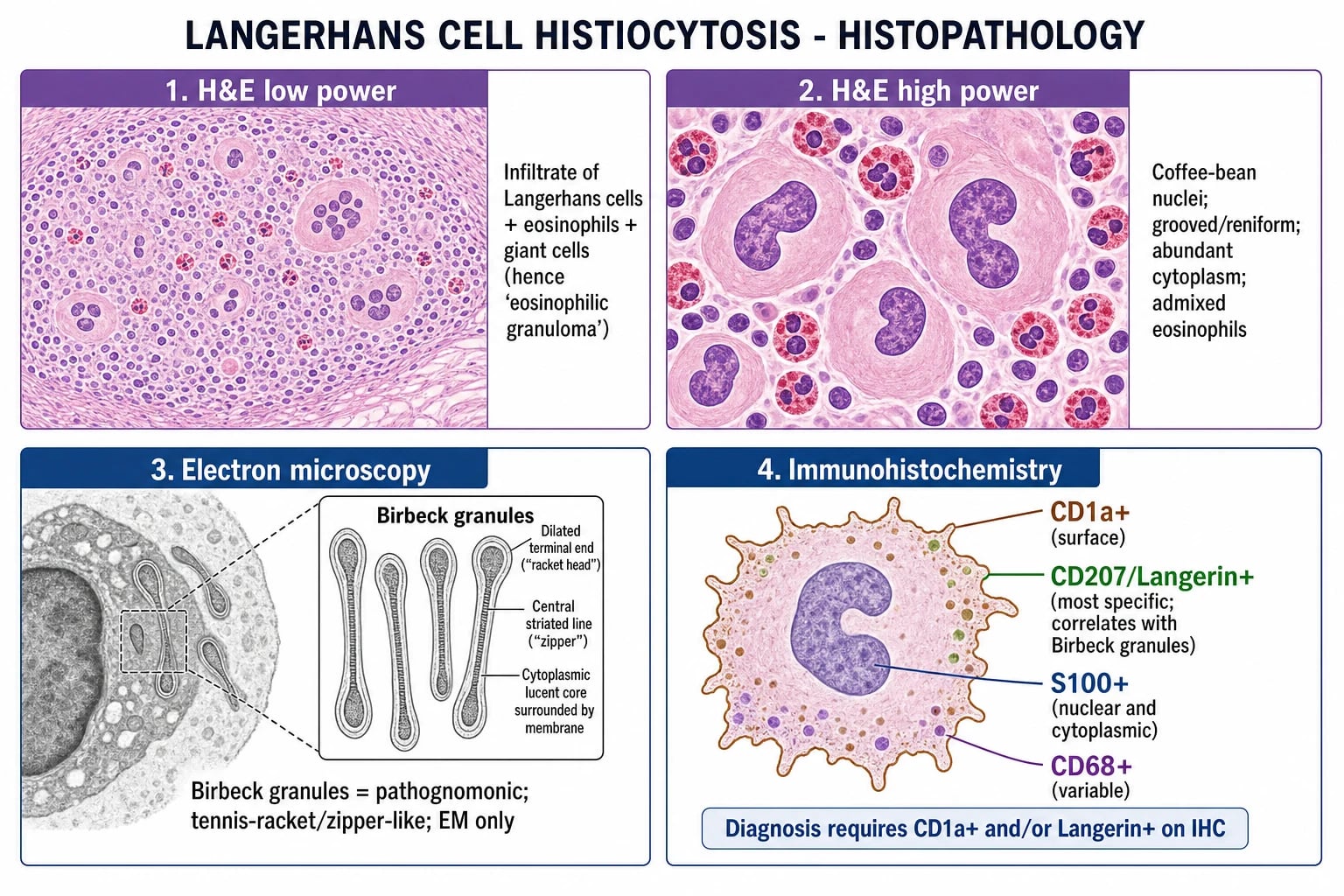 H&E showing Langerhans cells with coffee-bean nuclei + eosinophils; EM showing Birbeck granules (tennis racket); IHC: CD1a+, Langerin/CD207+, S100+