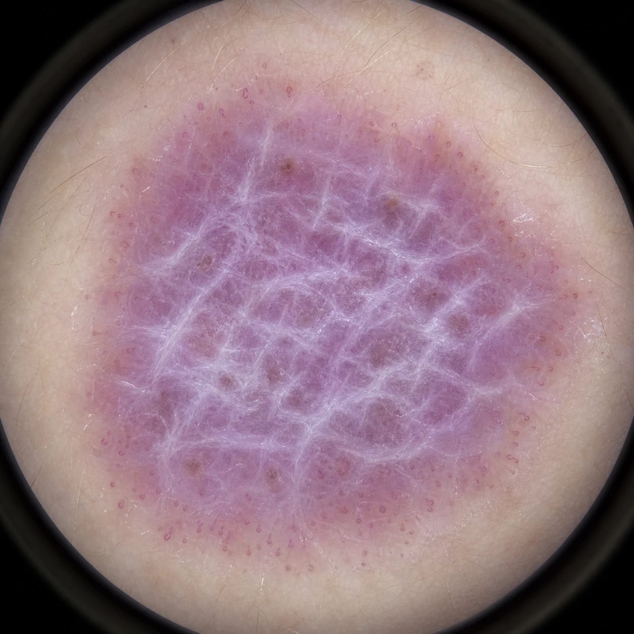 Dermoscopy of lichen planus showing pearly white reticular Wickham striae on a violaceous background with peripheral dotted vessels