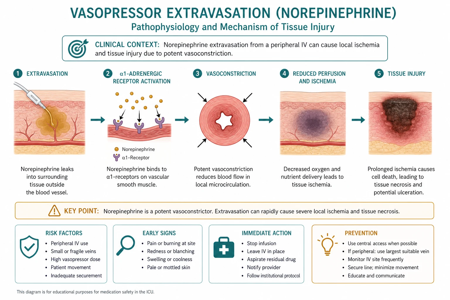 Swiss-cheese model of ICU medication error: prescribing transcription dispensing administration monitoring stages, high-alert drugs insulin anticoagulants opioids electrolytes vasoactives, educational infographic