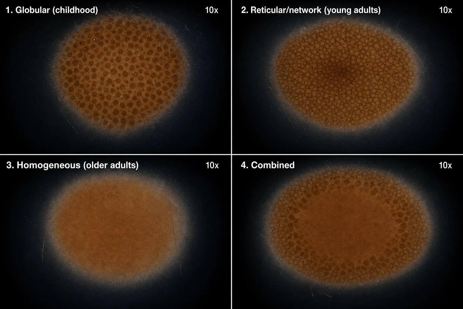 Four benign naevus dermoscopy patterns: globular (childhood), reticular network (young adults), homogeneous (older adults), and combined