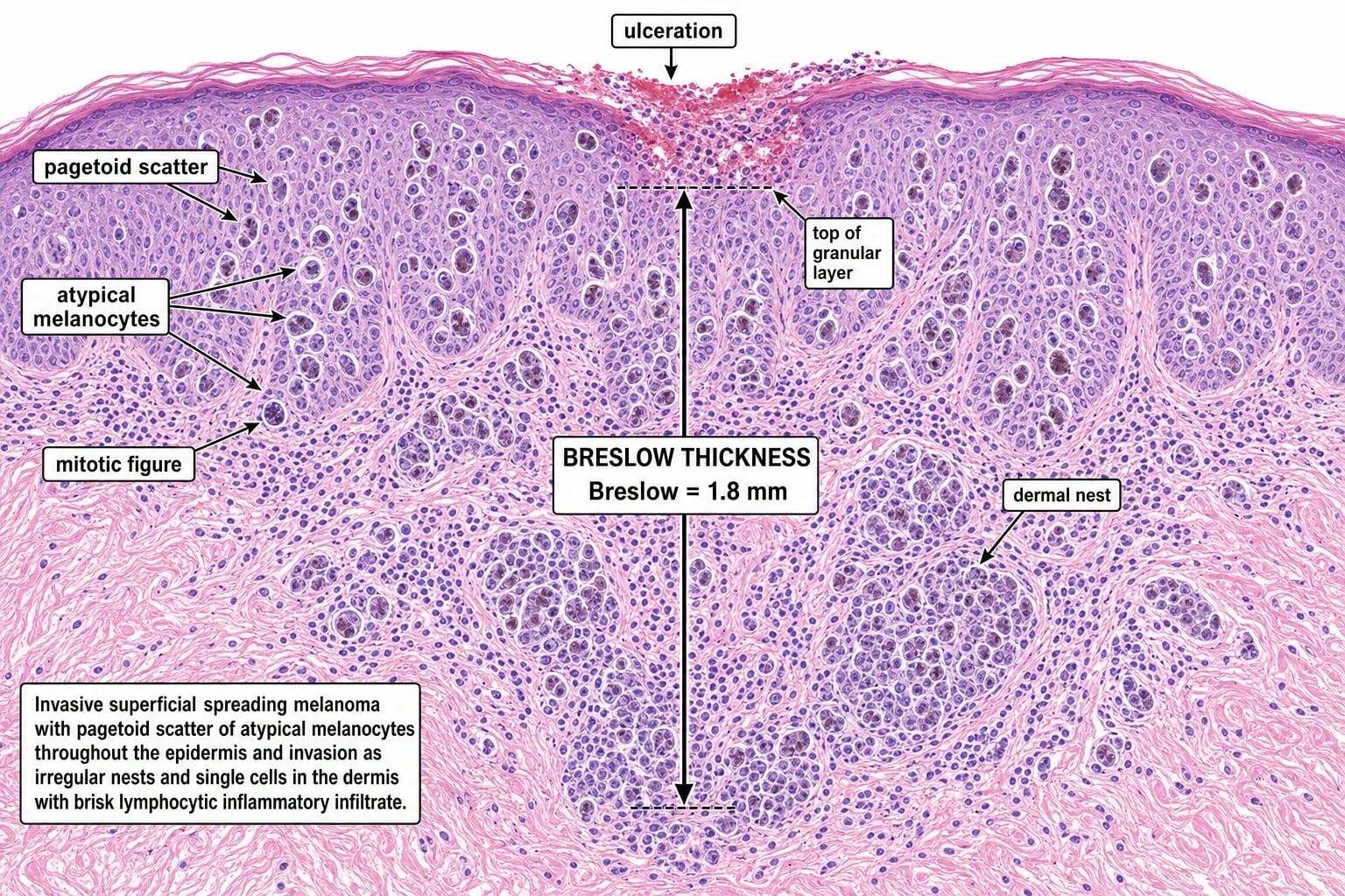 H&E histopathology of invasive melanoma showing pagetoid scatter, atypical melanocytes and Breslow thickness measured from the granular layer to the deepest invasive point