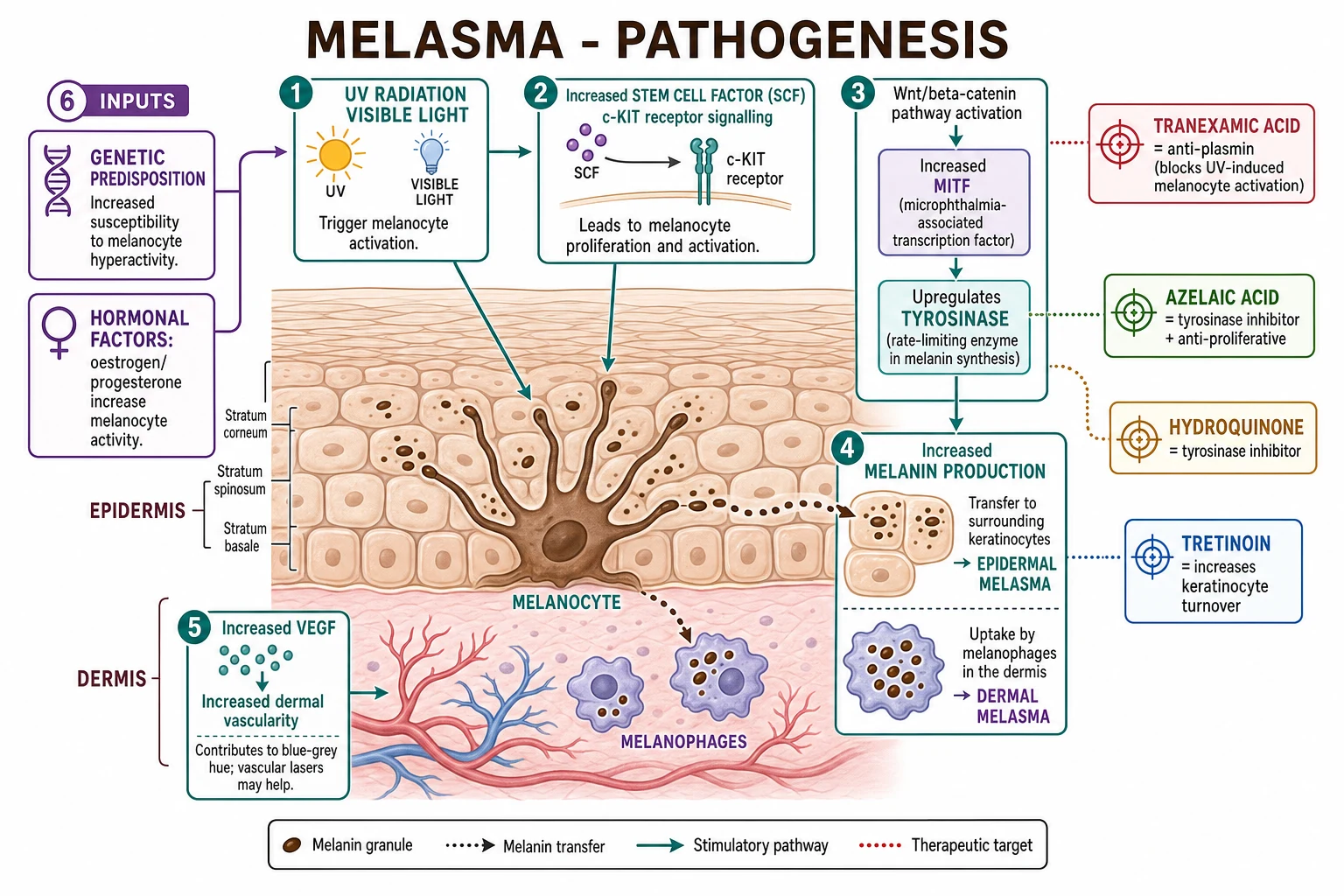 Pathogenesis cascade: UV/visible light activates keratinocytes to release SCF, which binds c-KIT on melanocytes; Wnt/β-catenin increases MITF; tyrosinase is upregulated; melanin is deposited in keratinocytes and falls into the dermis through basement membrane gaps.