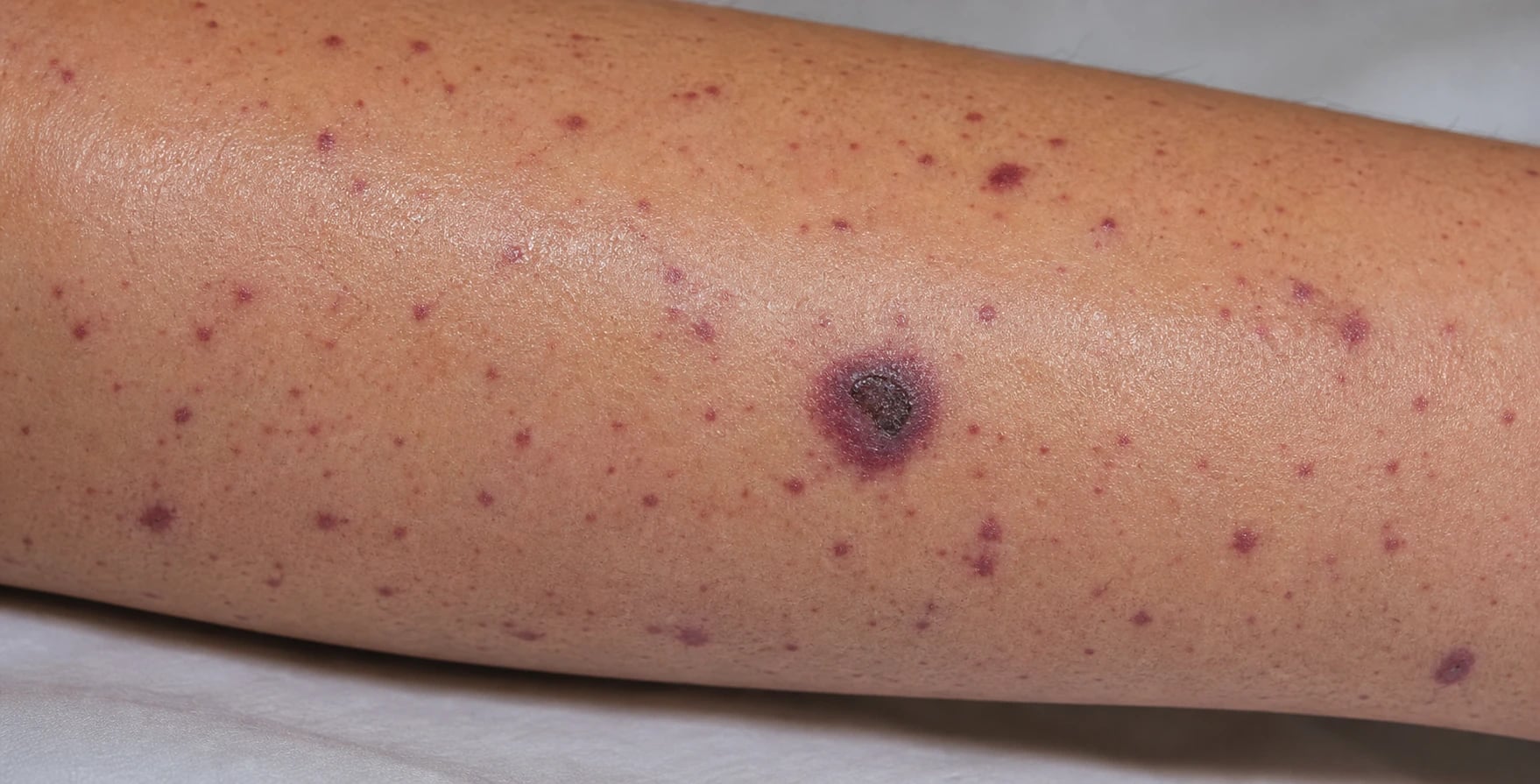 Petechial/purpuric non-blanching rash with fever; Neisseria meningitidis; glass test positive; IV ceftriaxone immediately