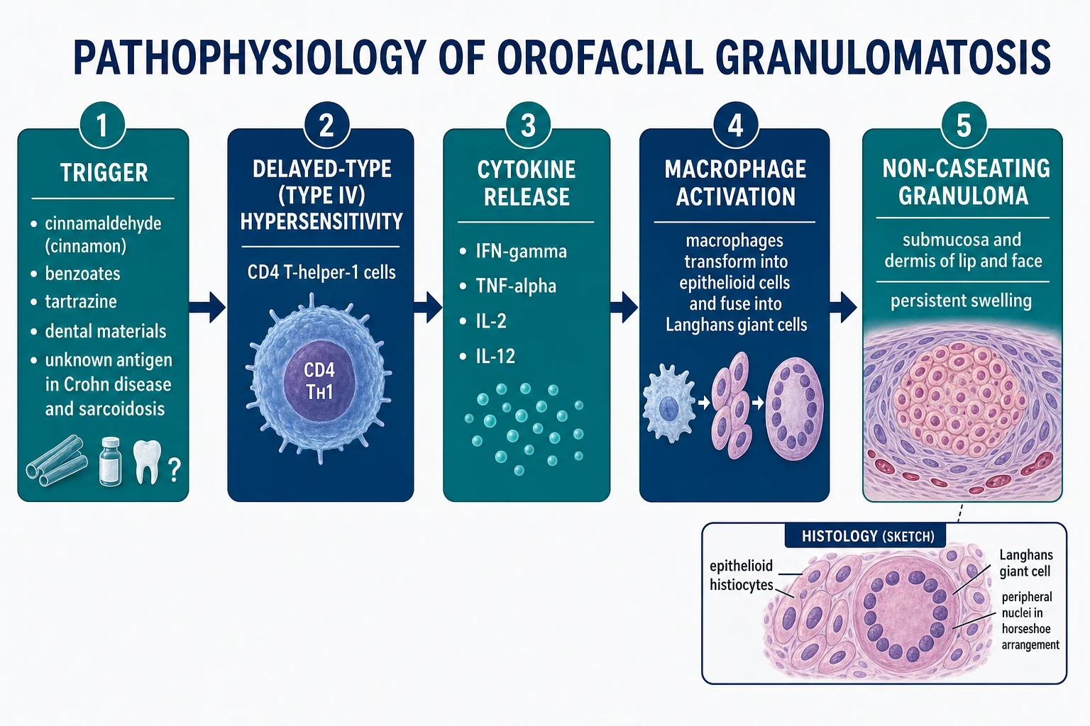 Flowchart of the immunological cascade in orofacial granulomatosis: antigen trigger, delayed-type hypersensitivity via CD4 Th1 cells, cytokine release of IFN-gamma and TNF-alpha, macrophage activation into epithelioid cells and Langhans giant cells, and formation of non-caseating granulomas in the lip submucosa