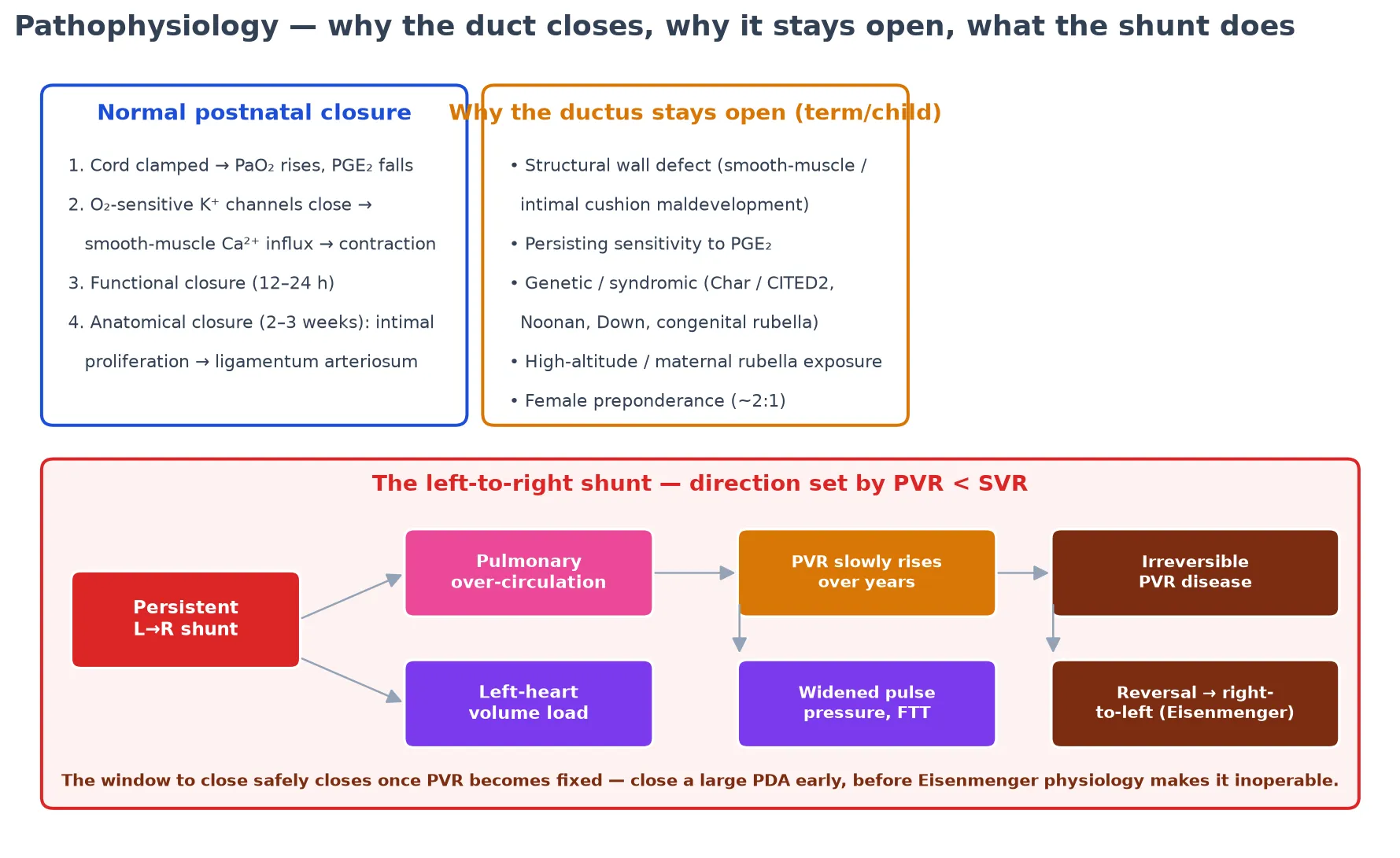 Educational schematic of normal postnatal ductal closure (oxygen rise and prostaglandin fall driving smooth-muscle contraction), the reasons a term ductus stays open, and the downstream consequences of the left-to-right shunt from pulmonary over-circulation through rising pulmonary vascular resistance to irreversible Eisenmenger reversal