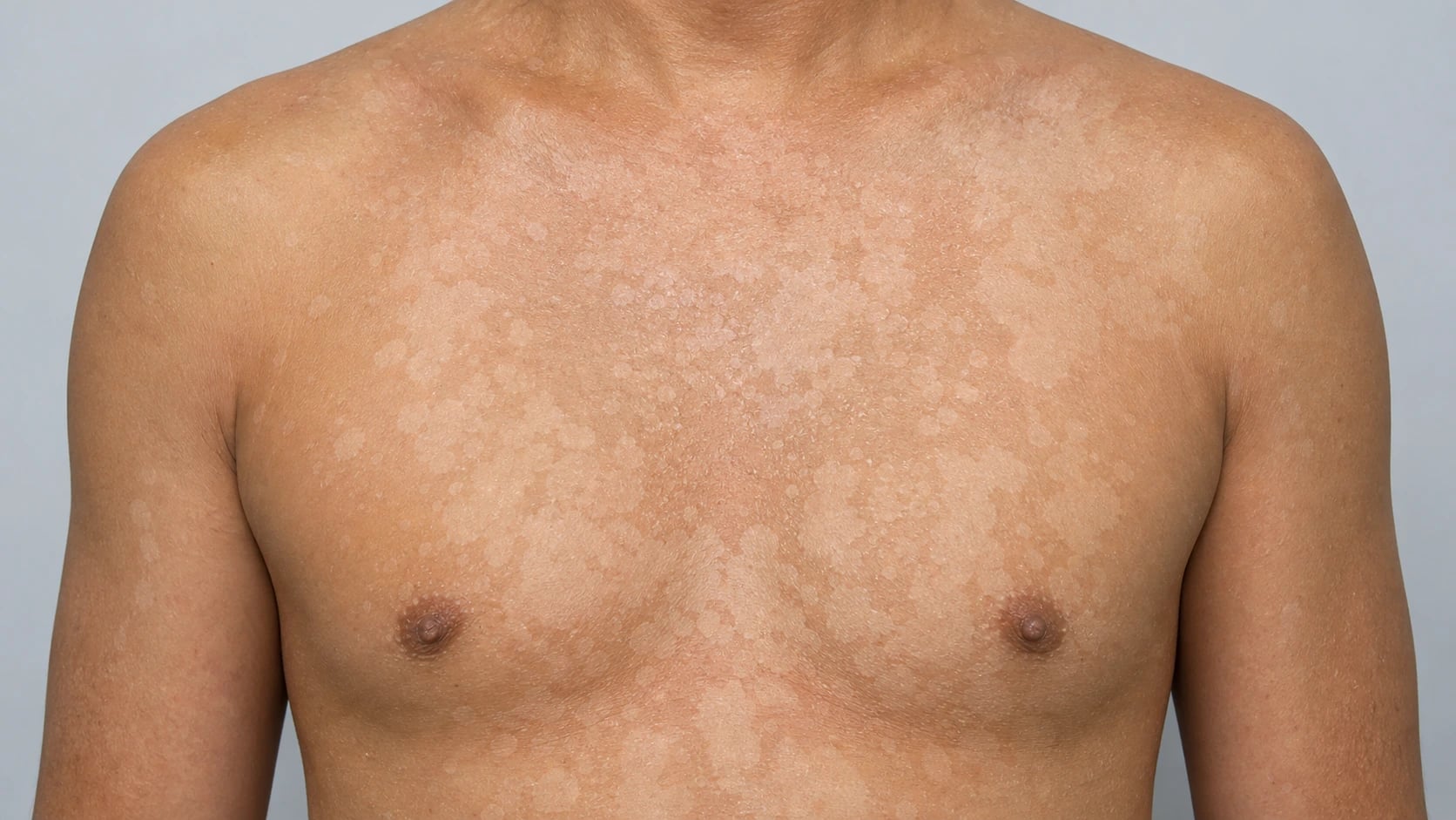 Malassezia overview: lipophilic yeast colonising sebaceous skin, with four clinical syndromes — pityriasis versicolor (hypo/hyperpigmented scaly macules), Malassezia folliculitis (monomorphic itchy papules), seborrhoeic dermatitis (greasy yellow scale), and invasive catheter infection