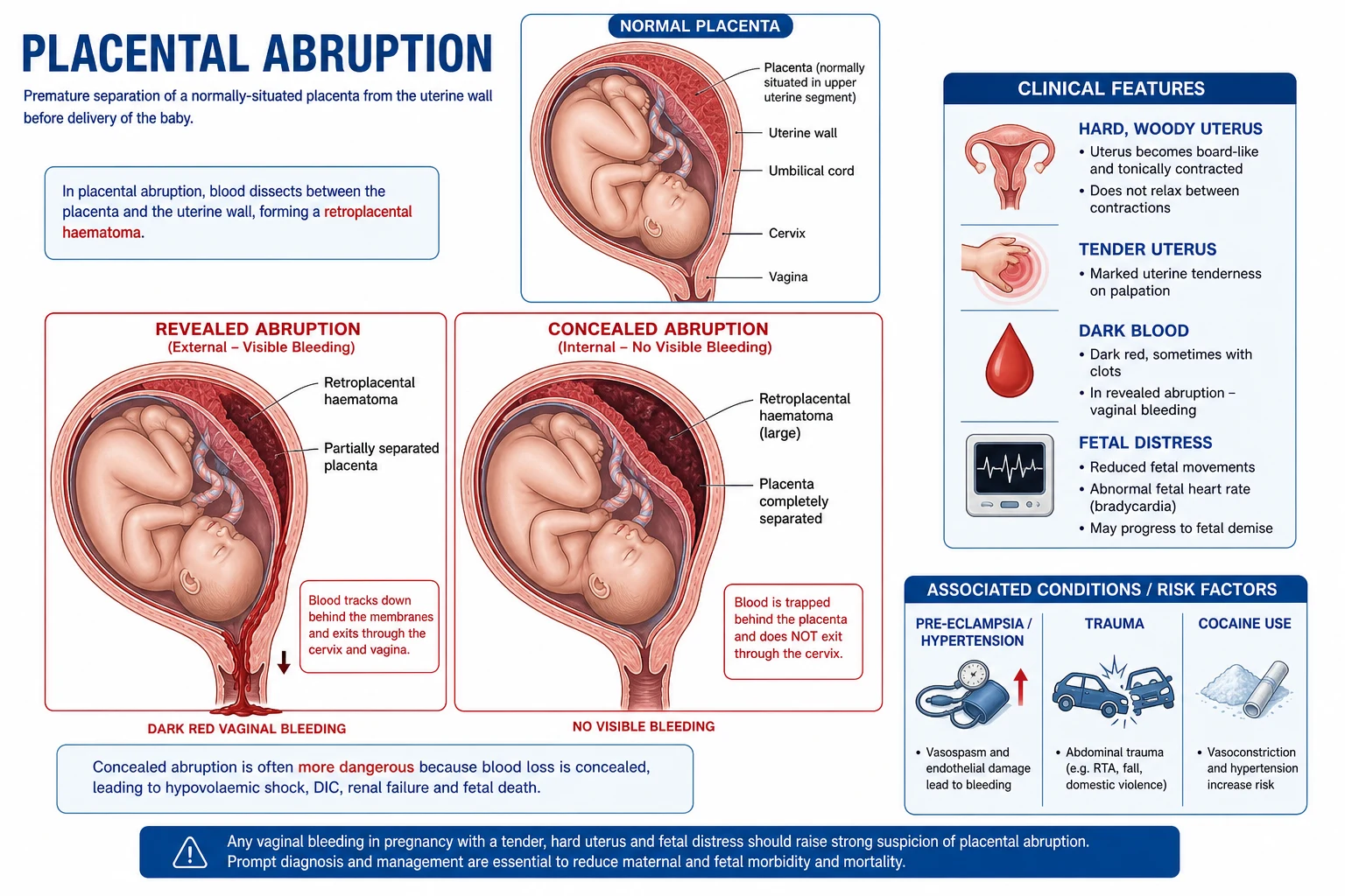 Placental abruption showing revealed versus concealed bleeding and the retroplacental clot.