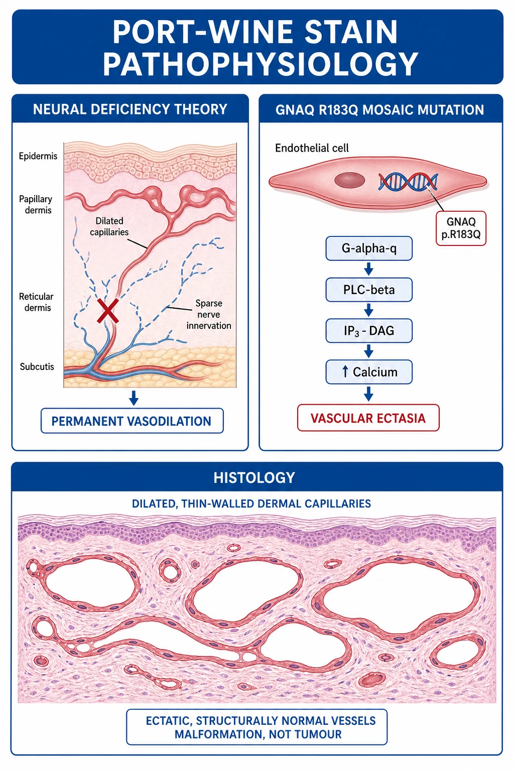 Pathophysiology diagram: neural deficiency theory (reduced sympathetic innervation, loss of vascular tone, permanent ectasia) and GNAQ R183Q mosaic mutation (Gαq, PLCβ, IP3/DAG, calcium, progressive ectasia); histology shows ectatic structurally normal dermal capillaries