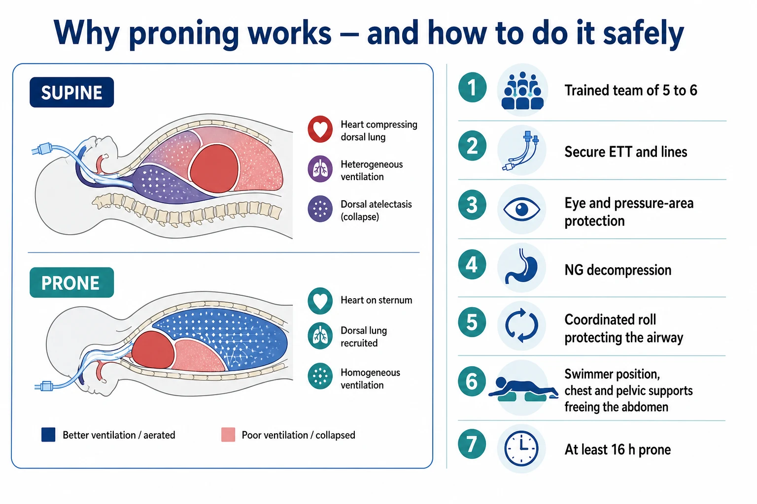 Two-panel infographic on a white clinical-blue background: LEFT a sagittal chest diagram, SUPINE (heart compressing dorsal lung, heterogeneous ventilation, dorsal atelectasis) vs PRONE (heart on sternum, dorsal lung recruited, homogeneous ventilation); RIGHT a numbered checklist — 1 trained team of 5 to 6, 2 secure ETT and lines, 3 eye and pressure-area protection, 4 NG decompression, 5 coordinated roll protecting the airway, 6 swimmer position with chest and pelvic supports freeing the abdomen, 7 at least 16 h prone. Flat vector illustration, crisp typography.