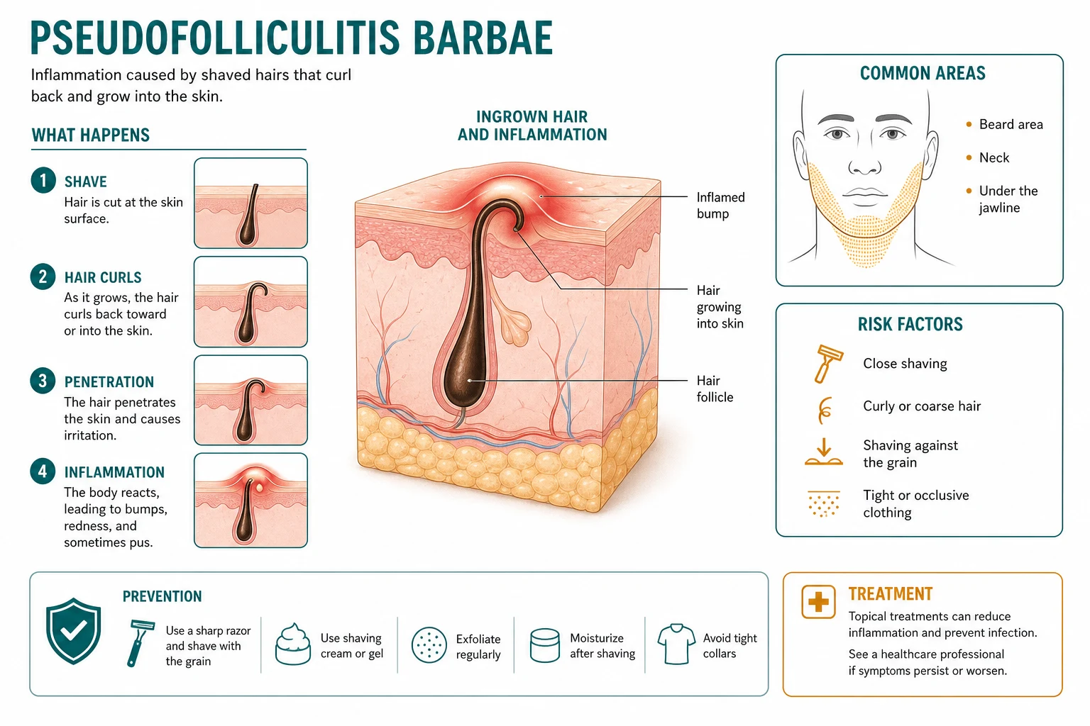 Schematic cross-section of the skin showing the two mechanisms of hair re-entry in pseudofolliculitis barbae: extrafollicular penetration where the curved tip pierces the skin surface adjacent to the follicle, and transfollicular penetration where the hair pierces the follicular wall into the dermis, both triggering a foreign-body granulomatous reaction