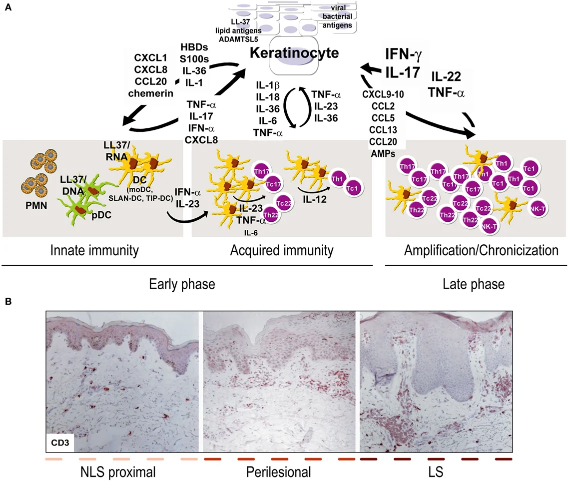 Diagram showing the interplay between keratinocytes and immune cells in psoriasis, including innate immunity, acquired immunity, and amplification phases