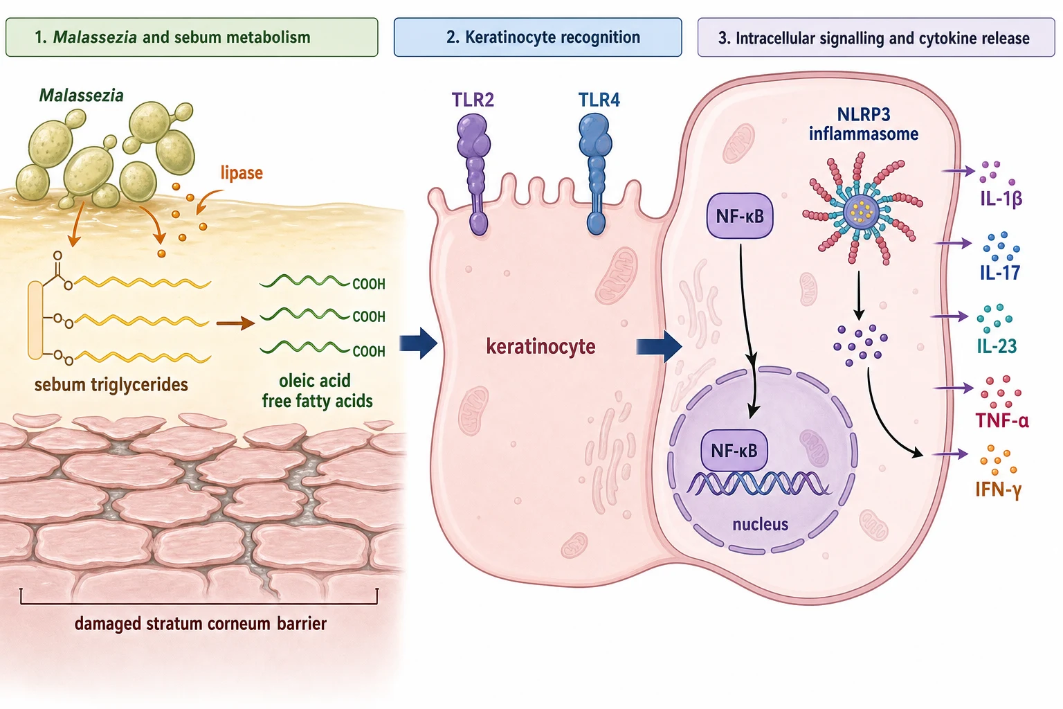 Diagram showing Malassezia yeast lipase activity releasing oleic acid, TLR activation, NF-κB and NLRP3 inflammasome signalling, and downstream IL-1β, IL-17, IL-23 and TNF-α release in seborrhoeic dermatitis