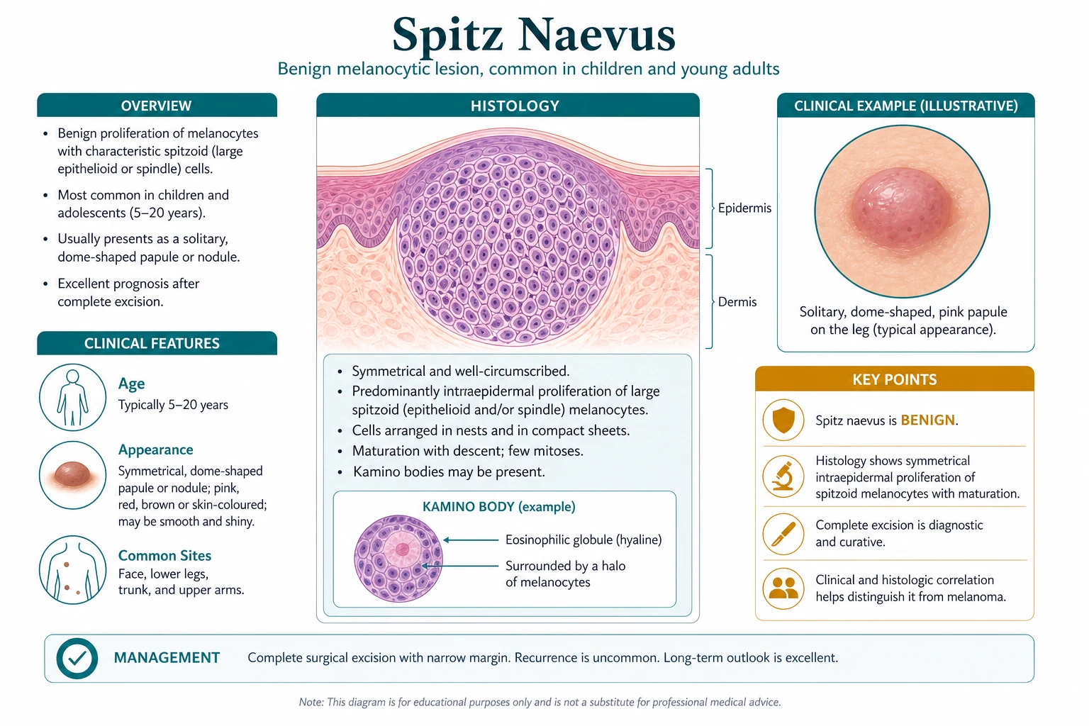 Histopathology panel of Spitz naevus showing spindled epithelioid melanocytes, Kamino bodies, and S100 positivity