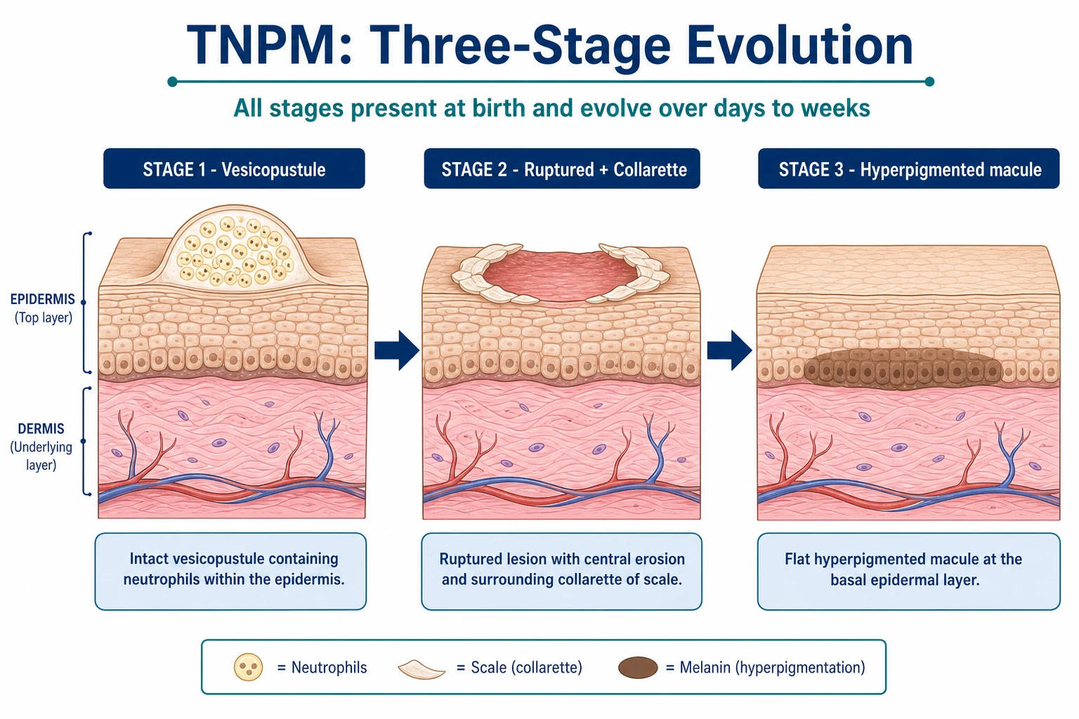 Schematic cross-section diagram of the three sequential evolution stages of TNPM lesions: stage 1 superficial vesicopustule, stage 2 ruptured pustule with collarette of scale, stage 3 residual hyperpigmented macule