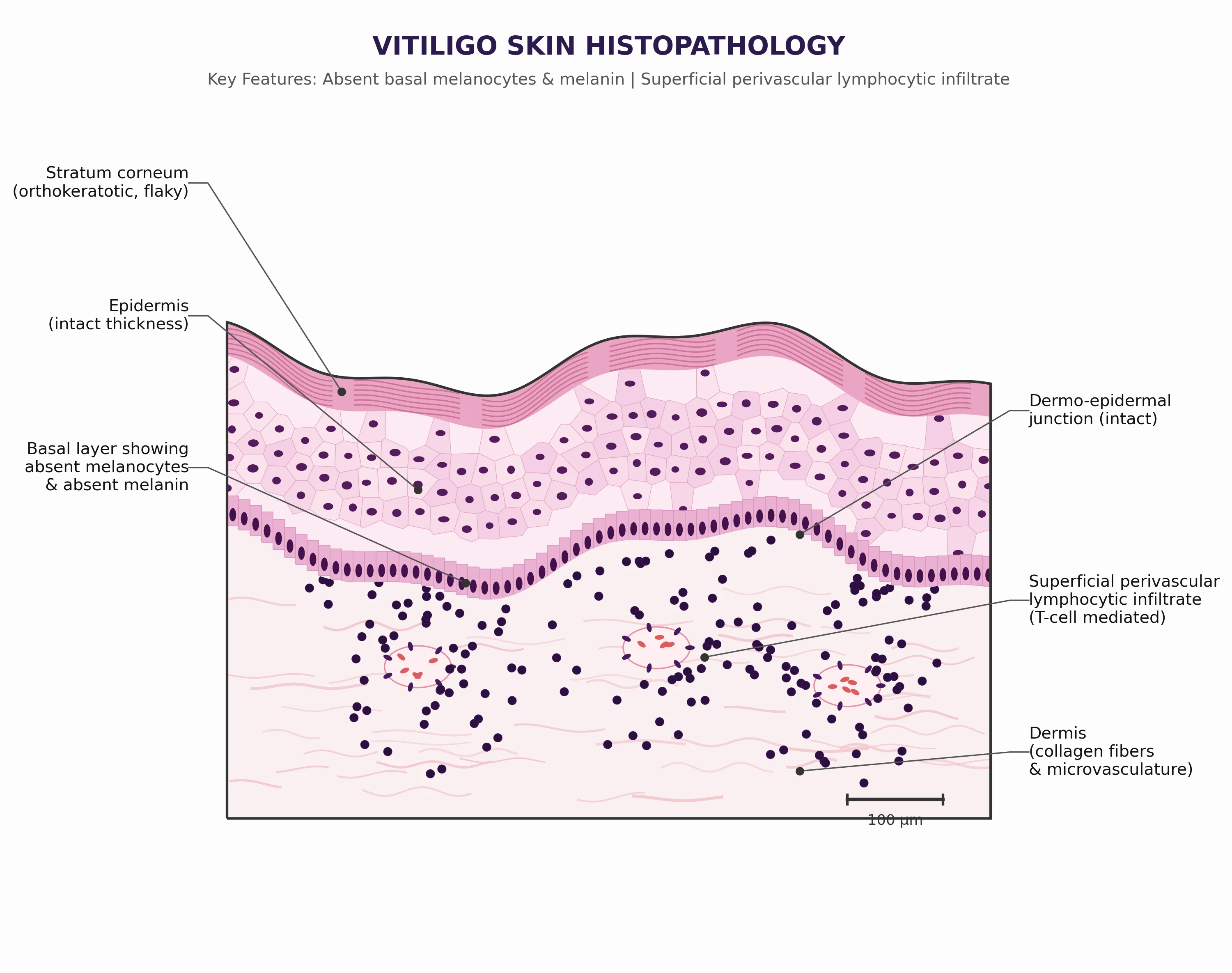 Histopathology diagram showing loss of melanocytes and melanin in the basal epidermis with a superficial lymphocytic infiltrate