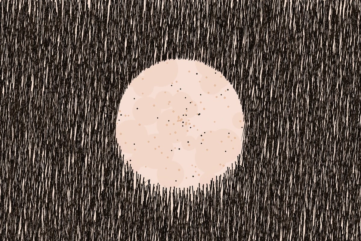 Well-demarcated round patch of non-scarring hair loss on the scalp with exclamation-mark hairs at the margin