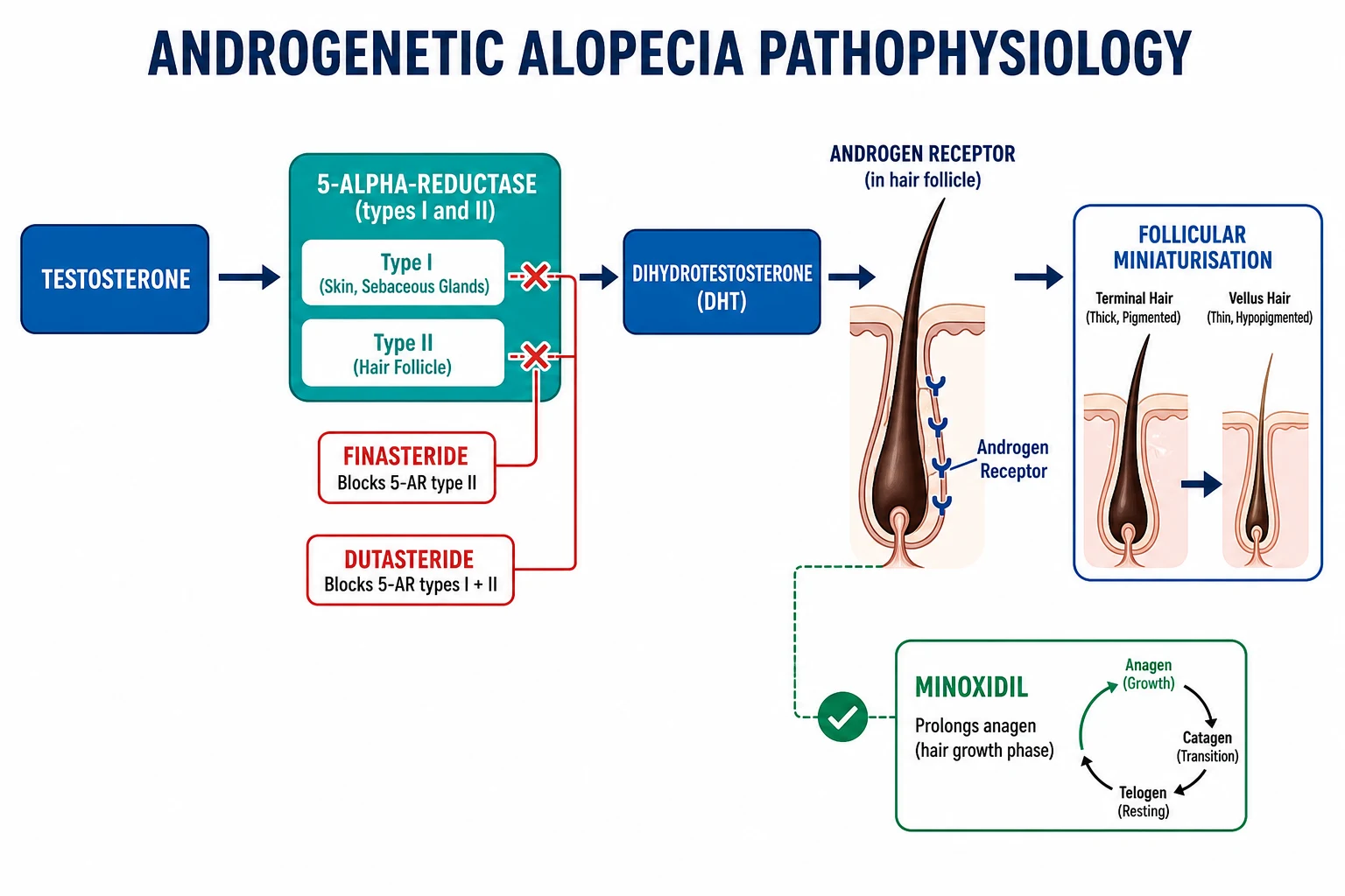 DHT pathophysiology cascade: testosterone → 5-alpha-reductase (types I and II) → dihydrotestosterone → binds androgen receptor in dermal papilla cells of susceptible scalp follicles → shortened anagen + terminal-to-vellus conversion → progressive miniaturisation; finasteride blocks 5-AR II, dutasteride blocks 5-AR I and II, minoxidil prolongs anagen independently