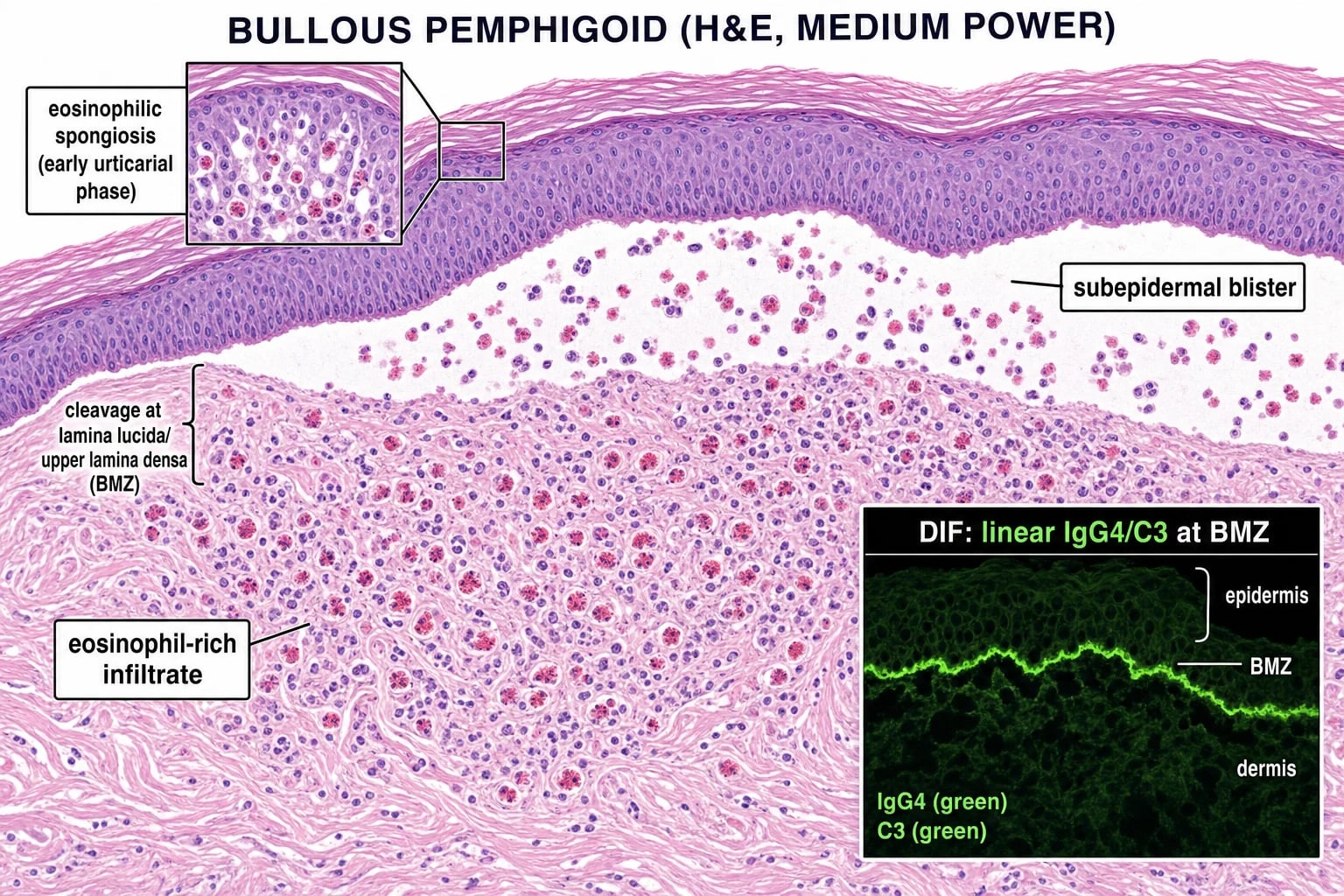 H&E showing subepidermal blister with eosinophil-rich infiltrate, and DIF inset showing linear IgG4/C3 at the basement membrane zone