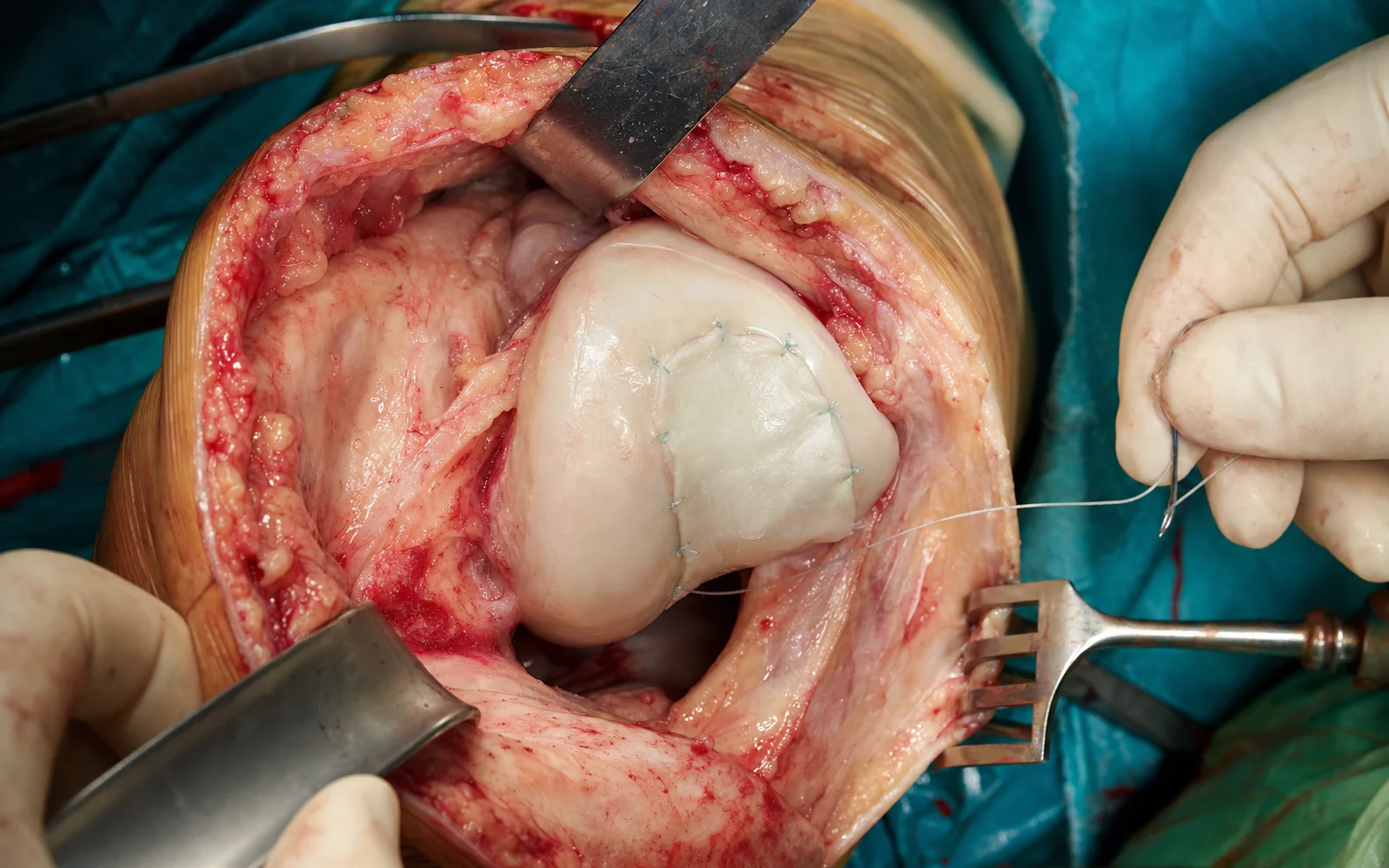 Cinematic 3D illustration of a failing dilated left ventricle with poor contraction, low forward cardiac output, raised filling pressures, congested lungs, and cool hypoperfused peripheries
