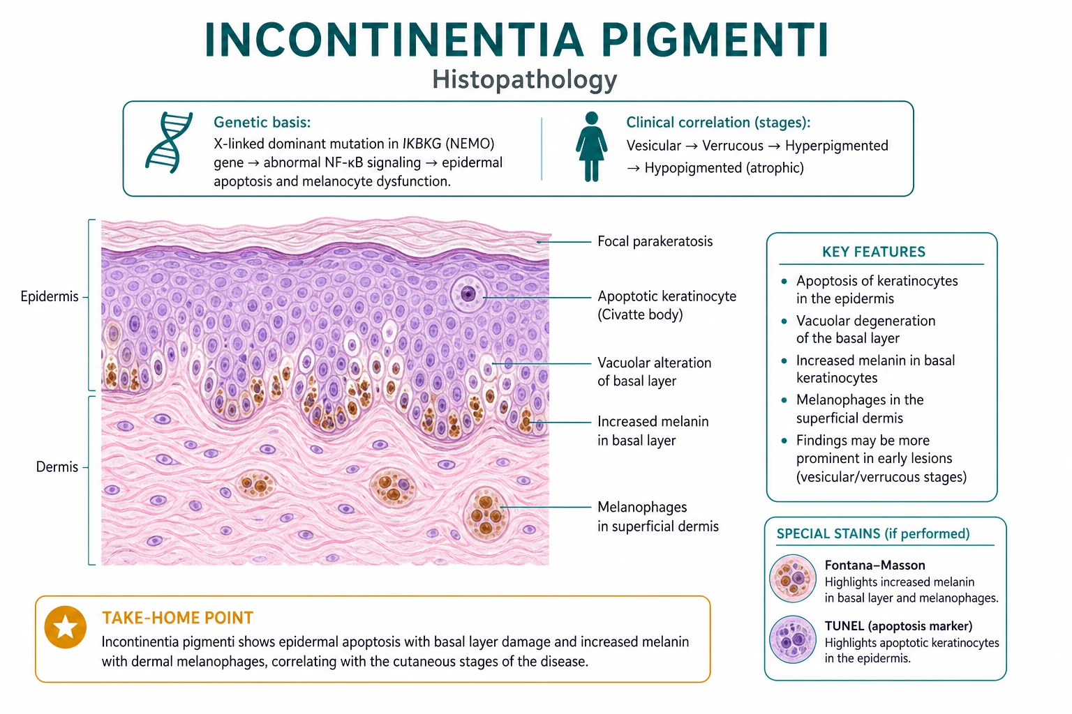 Stage-dependent histopathology of incontinentia pigmenti: eosinophilic spongiosis, verrucous hyperkeratosis, melanin incontinence with melanophages, and epidermal atrophy