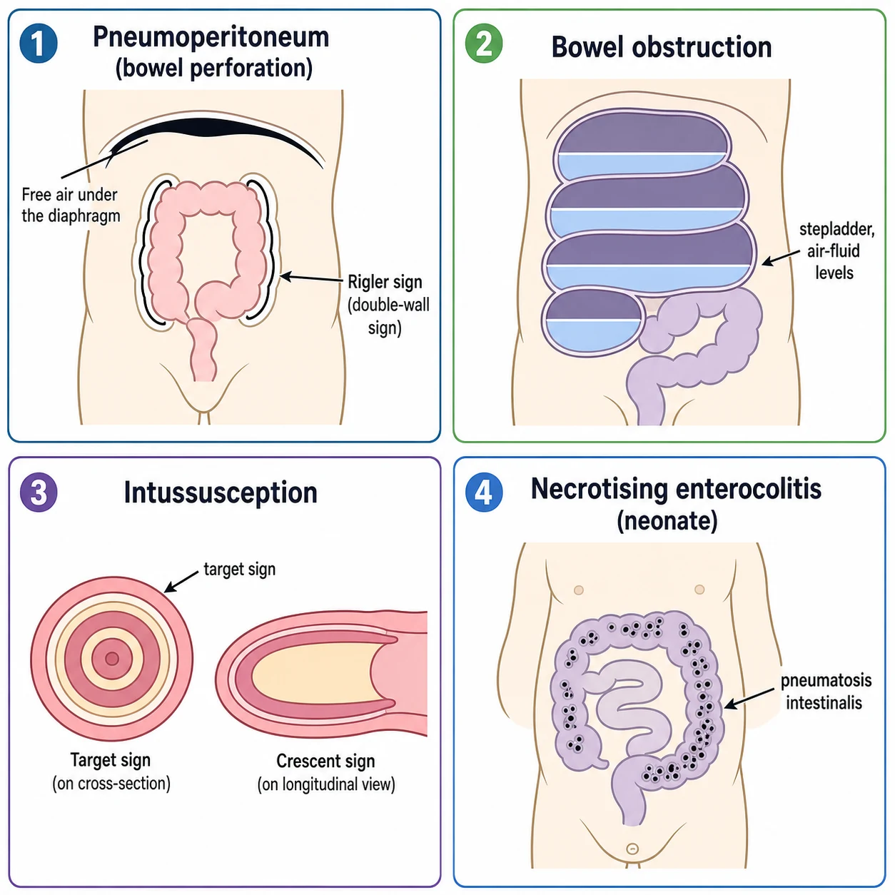 A clean medical-education schematic on a white background teaching the key radiographic signs of acute paediatric abdominal emergencies using simple labelled flat cartoon diagrams that are not real radiographs. Four panels in a 2 by 2 grid. Panel 1 pneumoperitoneum shows a rounded abdomen outline with free air as bright arcs on both sides of the bowel wall called Rigler double-wall sign and a curved lucency under the diaphragm. Panel 2 bowel obstruction shows dilated bowel loops stacked like a stepladder with multiple air-fluid levels. Panel 3 intussusception shows a target-like concentric ring target sign and a crescent sign. Panel 4 necrotising enterocolitis in the neonate shows a small abdomen with bubbly streaky lucencies in the bowel wall called pneumatosis intestinalis. Flat educational vector style with crisp legible English labels.