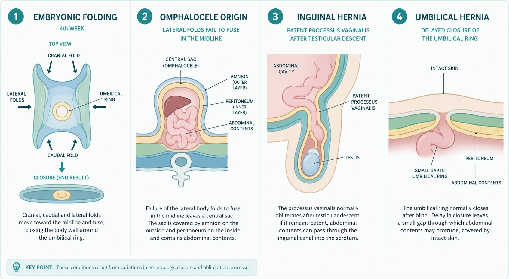 Four-panel embryology diagram. Panel one shows the four-week embryo with cranial caudal and lateral folds converging on the umbilical ring, with a persistent midline gap where lateral folds fail producing an omphalocele. Panel two shows disruption of the right paraumbilical body wall with bowel herniating through a full-thickness defect and no sac, the gastroschisis mechanism. Panel three shows the processus vaginalis failing to obliterate after testicular descent so bowel enters the inguinal canal. Panel four shows delayed fibrous closure of the umbilical ring leaving a fascial defect with intact overlying skin.
