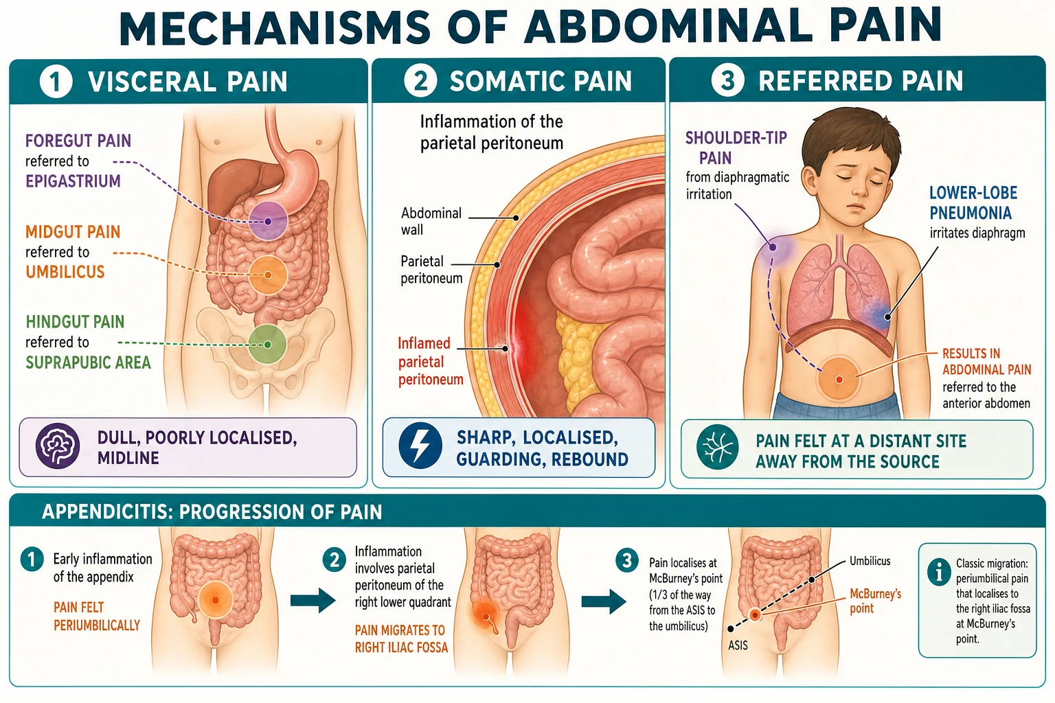 Pathophysiology diagram of abdominal pain pathways showing visceral pain from midgut structures referred to the periumbilical region via the tenth thoracic to first lumbar spinal segments, somatic pain from parietal peritoneum localising precisely to the affected quadrant, and referred pain, with an inset showing appendiceal luminal obstruction progressing to inflammation, ischaemia and perforation.