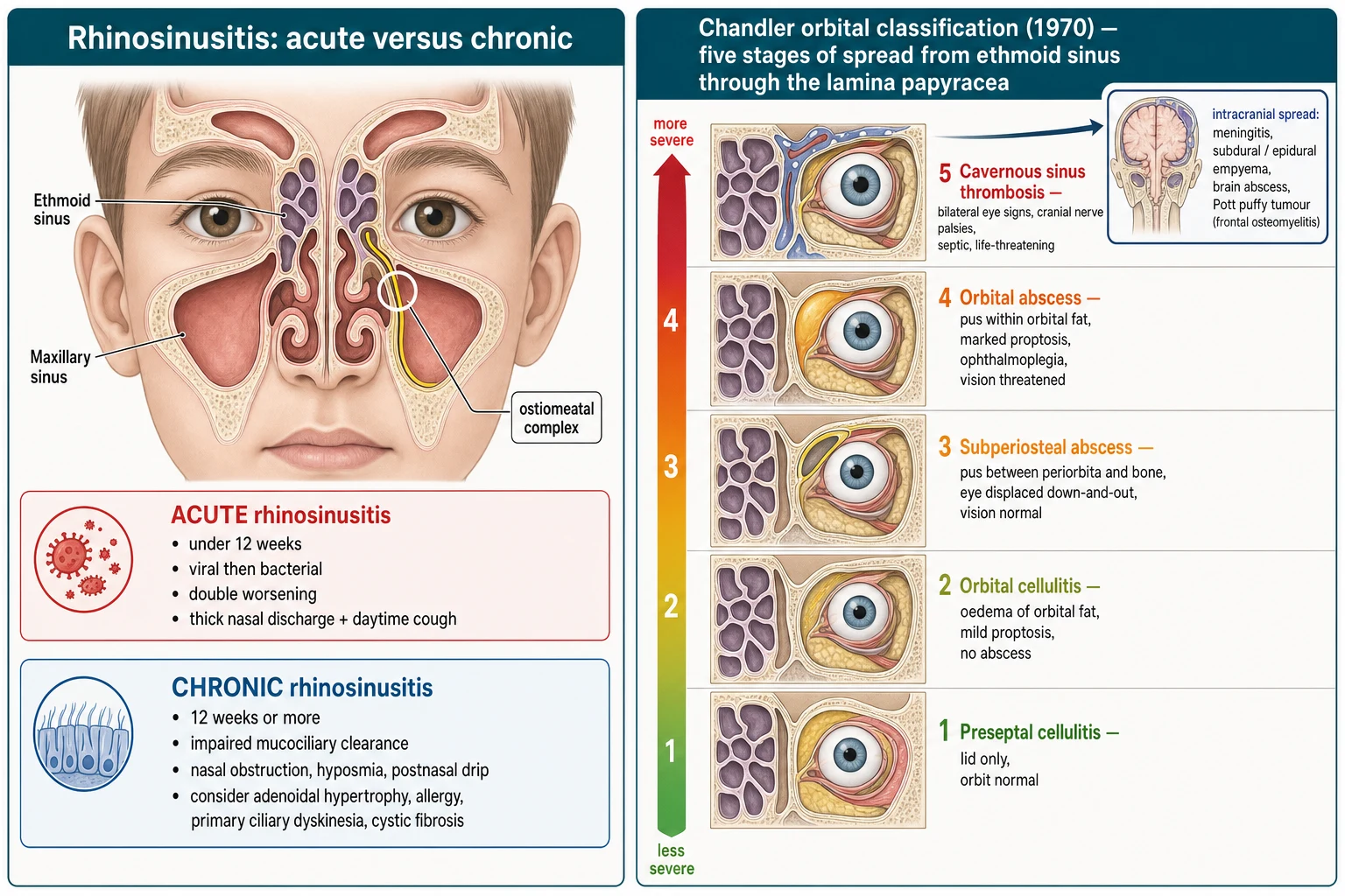 Two-panel schematic of rhinosinusitis classification: the left panel is a coronal cross-section of a child's face showing the maxillary and ethmoid sinuses draining through the highlighted ostiomeatal complex, with two stacked cards contrasting acute rhinosinusitis (under twelve weeks, viral then bacterial, double worsening) in red and chronic rhinosinusitis (twelve weeks or more, impaired mucociliary clearance, with adenoidal hypertrophy, allergy, primary ciliary dyskinesia and cystic fibrosis) in blue; the right panel is the Chandler five-stage ladder of orbital spread from the ethmoid through the lamina papyracea, ascending from stage 1 preseptal cellulitis through stage 2 orbital cellulitis and stage 3 subperiosteal abscess to stage 4 orbital abscess and stage 5 cavernous sinus thrombosis, with a green-to-deep-red severity gradient and an inset arrow into the cranial cavity pointing to meningitis, subdural and epidural empyema, brain abscess and Pott puffy tumour