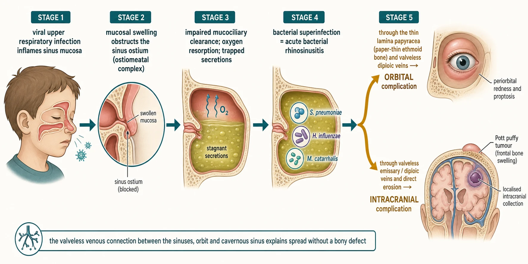 Left-to-right pathophysiology flow diagram of acute bacterial rhinosinusitis: a viral upper-respiratory infection inflames the sinus mucosa, mucosal swelling obstructs the ostium of the ostiomeatal complex, impaired mucociliary clearance traps stagnant secretions, bacterial superinfection by Streptococcus pneumoniae, Haemophilus influenzae and Moraxella catarrhalis produces acute bacterial rhinosinusitis, and the infection then diverges through the thin lamina papyracea to the orbit (periorbital redness and proptosis) and through the valveless diploic veins to the brain (a localised collection and a frontal Pott puffy tumour), with a footnote on the valveless venous connection explaining spread without a bony defect