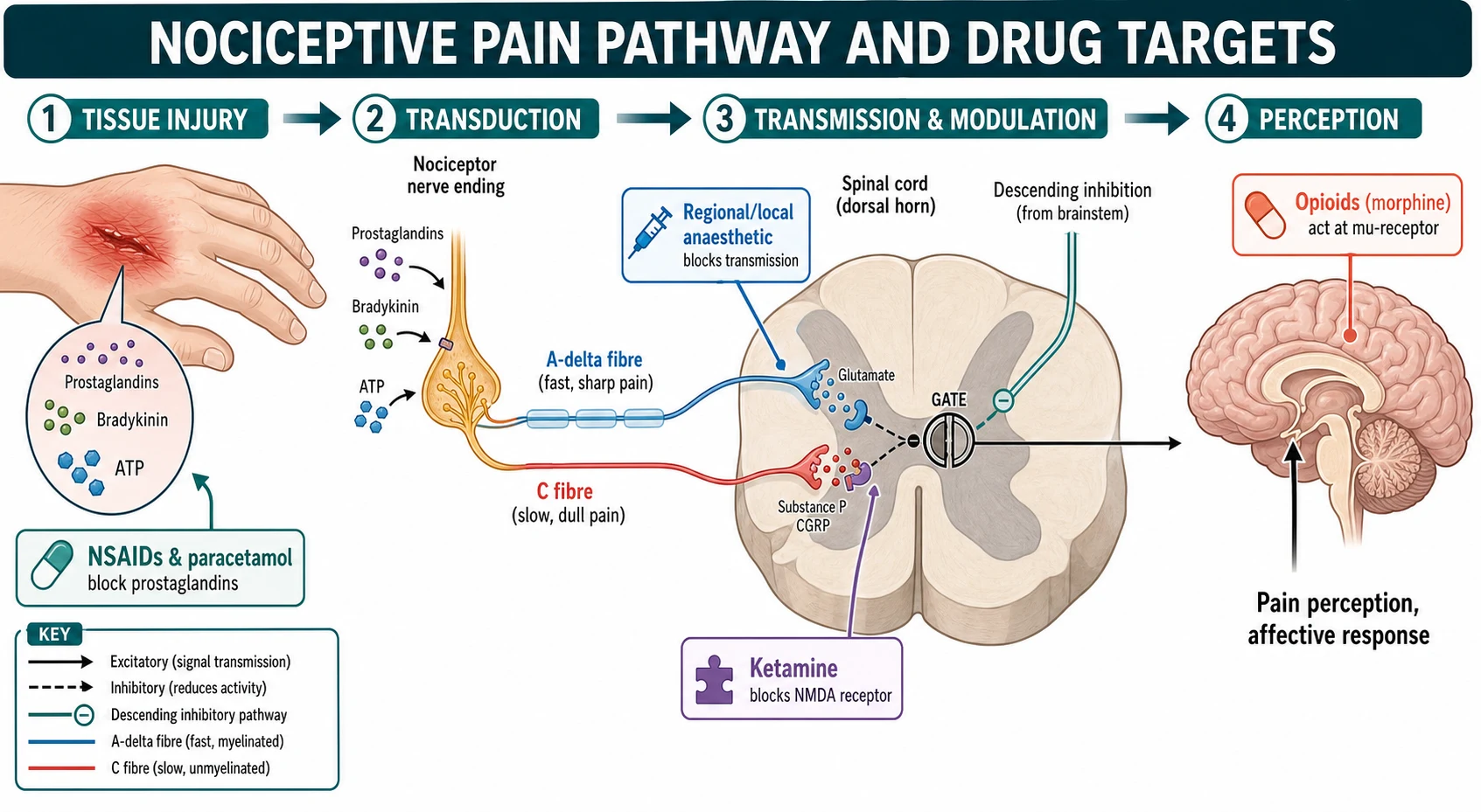 Reviewed educational mechanism diagram of the nociceptive pathway drawn left to right. Stage one tissue injury releases prostaglandins, bradykinin and ATP at a peripheral nociceptor. Stage two transmission along A-delta fast sharp and C slow dull fibres to the dorsal horn. Stage three modulation at a spinal gate with a descending inhibition arrow from the brainstem. Stage four perception in a brain icon. Coloured callouts show where NSAIDs and paracetamol block prostaglandins at the periphery, regional and local anaesthetic blocks transmission, ketamine blocks the NMDA receptor, and opioids act at the mu-receptor.