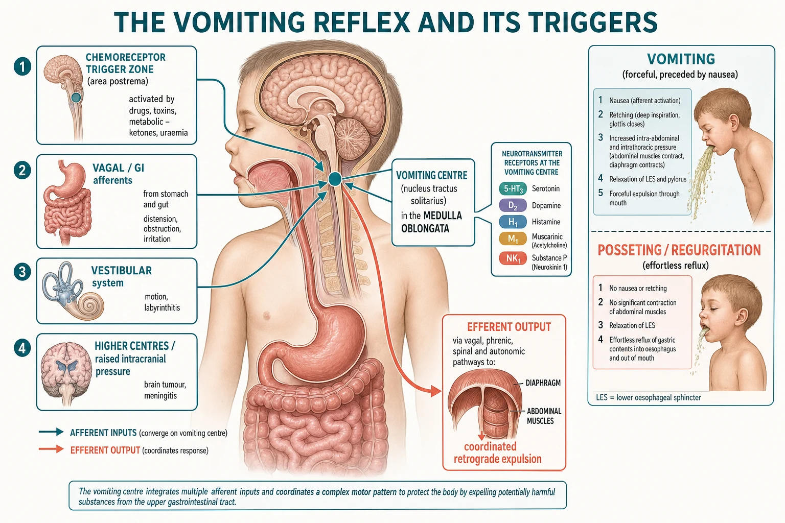 The vomiting reflex showing the brainstem vomiting centre in the medulla receiving four afferent inputs: the chemoreceptor trigger zone in the area postrema sensing drugs, toxins and ketones; vagal gastrointestinal afferents from distension and obstruction; the vestibular system; and higher centres and raised intracranial pressure, with efferent output to the diaphragm and abdominal muscles and the receptor targets 5-HT3, D2, H1, M1 and NK1.