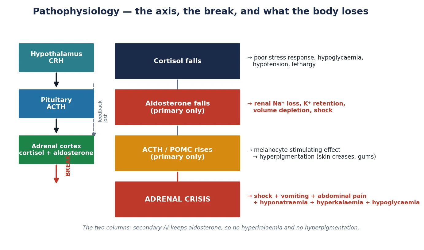 Pathophysiology diagram of the hypothalamic-pituitary-adrenal axis showing the adrenal break in primary disease with loss of cortisol and aldosterone, rising ACTH and hyperpigmentation, versus the pituitary or steroid-suppression break in secondary disease with cortisol loss alone and preserved aldosterone, leading down to adrenal crisis.