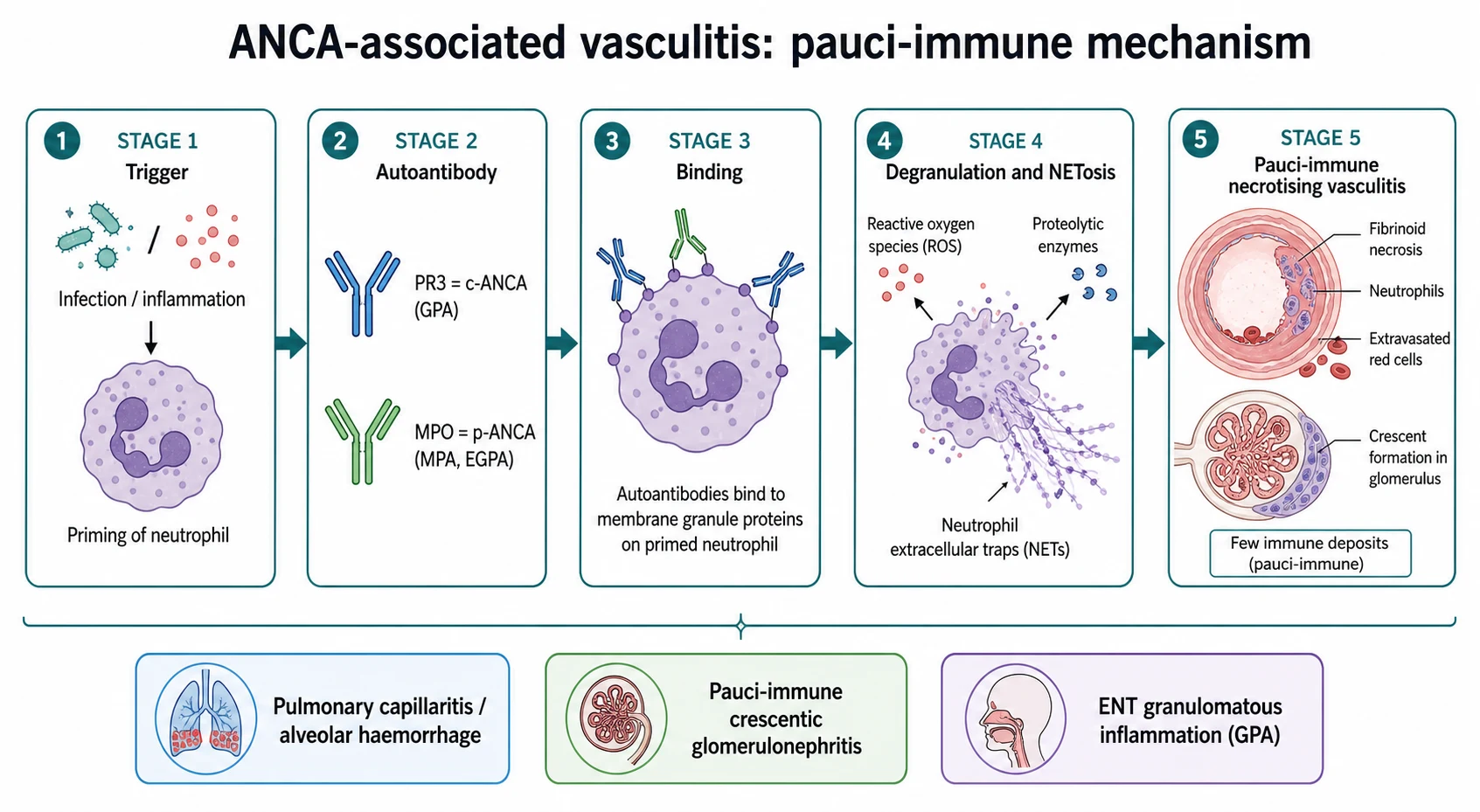A clean medical-education pathogenesis schematic on a white background titled ANCA-associated vasculitis pauci-immune mechanism. A left-to-right pipeline of five stages: trigger priming a neutrophil; autoantibodies tagged PR3 equals c-ANCA for GPA and MPO equals p-ANCA for MPA and EGPA; the antibody binding the primed neutrophil surface; degranulation and NETosis releasing enzymes and neutrophil extracellular traps; a small-vessel cross-section with fibrinoid necrosis, glomerular crescent and extravasated red cells with a few immune deposits note. A legend bar lists pulmonary capillaritis, pauci-immune crescentic glomerulonephritis, and ENT granulomatous inflammation.