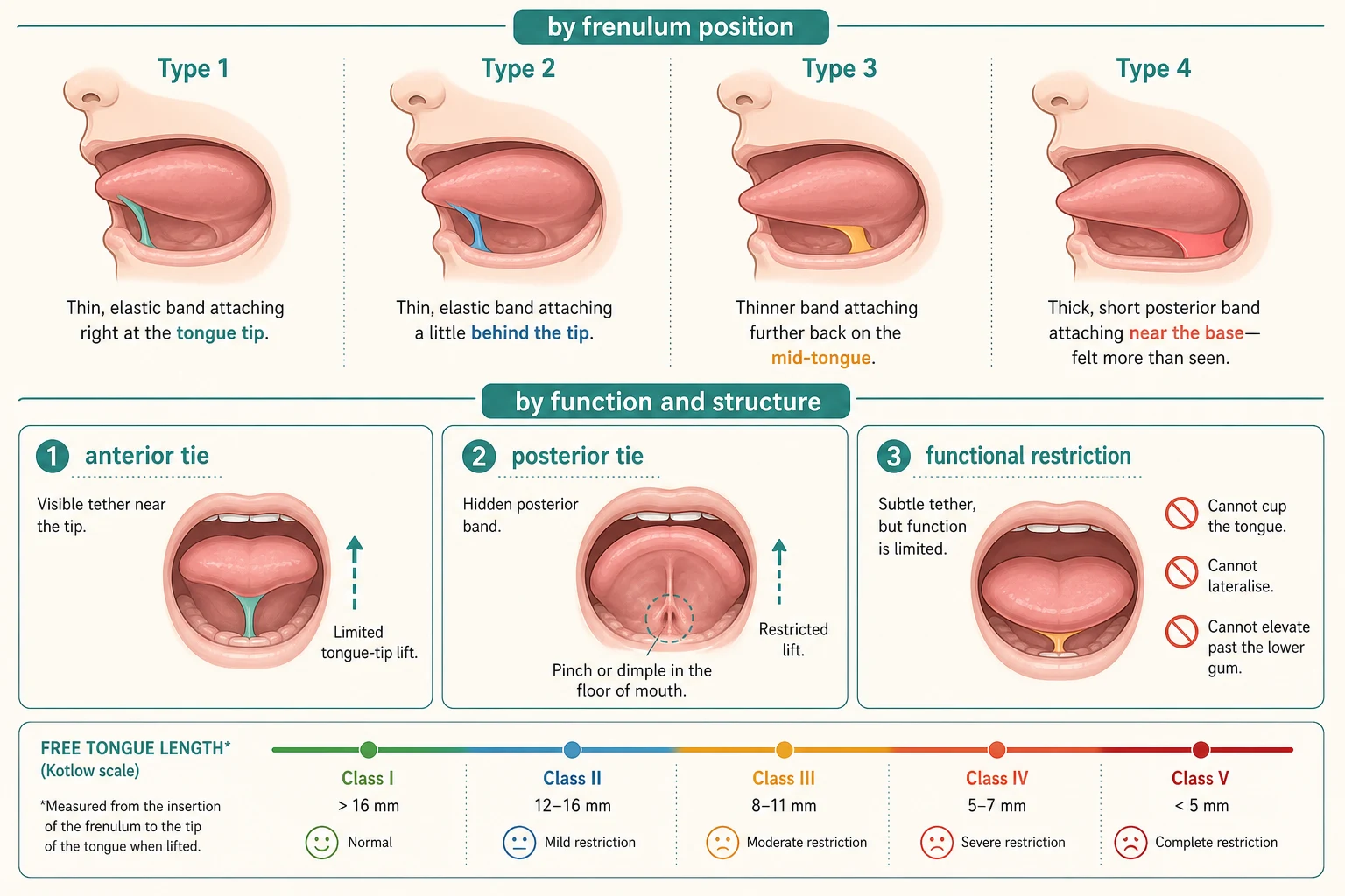 Two-row schematic of ankyloglossia classification: top row by frenulum position showing four infant-tongue-underneath profiles labelled type one to four from a thin tether at the tip to a thick posterior band at the base; bottom row by function and structure showing an anterior tie with a restricted tongue-tip lift, a posterior tie with a lifted tongue forming a pinch or dimple at the floor of mouth, and a functional restriction where the tongue cannot cup, lateralise or elevate past the lower gum, with a small free-tongue-length grading scale beneath.