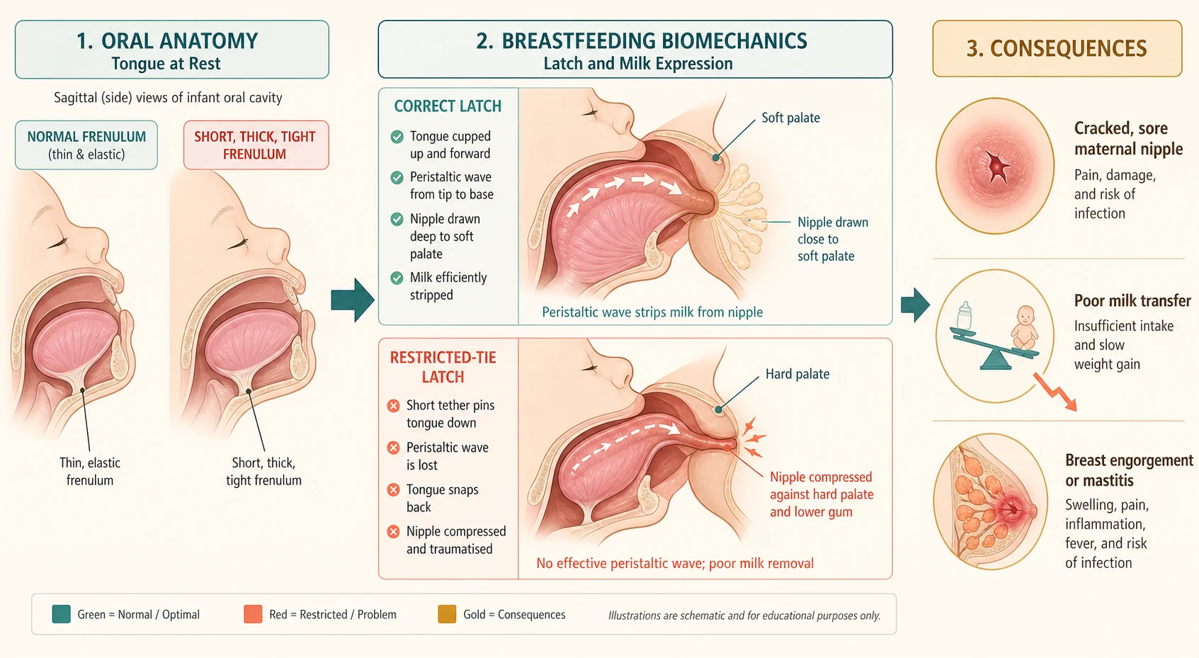 Left-to-right anatomical cascade: at far left two small comparison profiles of an infant oral cavity showing a normal thin frenulum beside a short thick tight frenulum; centre a latch biomechanics panel in cross-section with the tongue cupped up and forward driving a peristaltic wave that strips milk from a nipple held at the junction of the hard and soft palate, contrasted with a restricted-tie panel where the tethered tongue snaps back, the wave is lost, and the nipple is compressed and traumatised against the hard palate and lower gum with a compression-stripe marker; at right a consequence strip showing a cracked sore maternal nipple, poor milk transfer with a slow weight-gain arrow, and an engorged inflamed breast lobe representing mastitis.